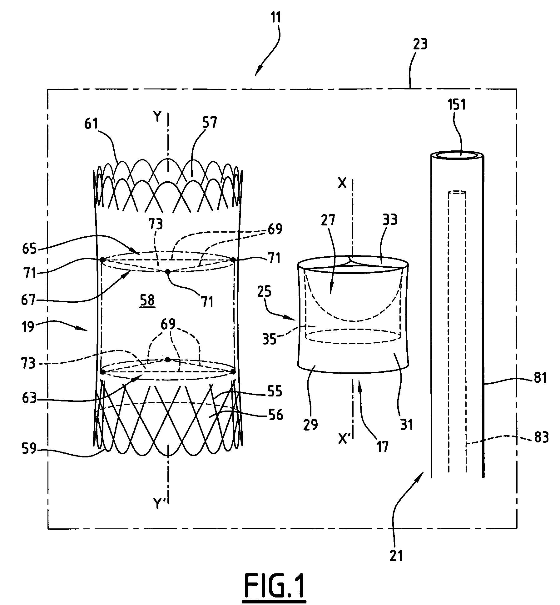 Kit to be implanted in a blood circulation conduit