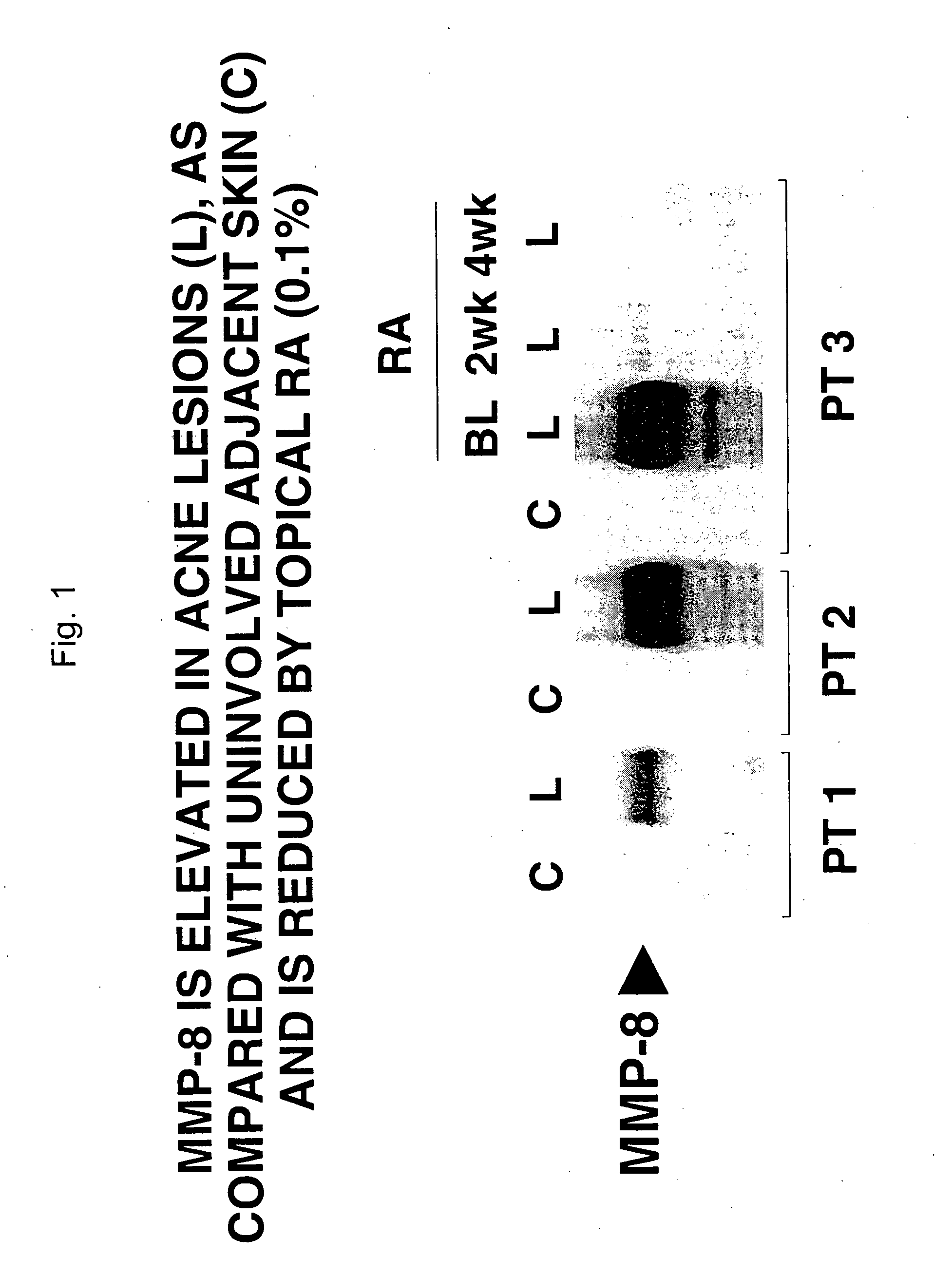 Compositions and methods for use against acne-induced inflammation and dermal matrix-degrading enzymes