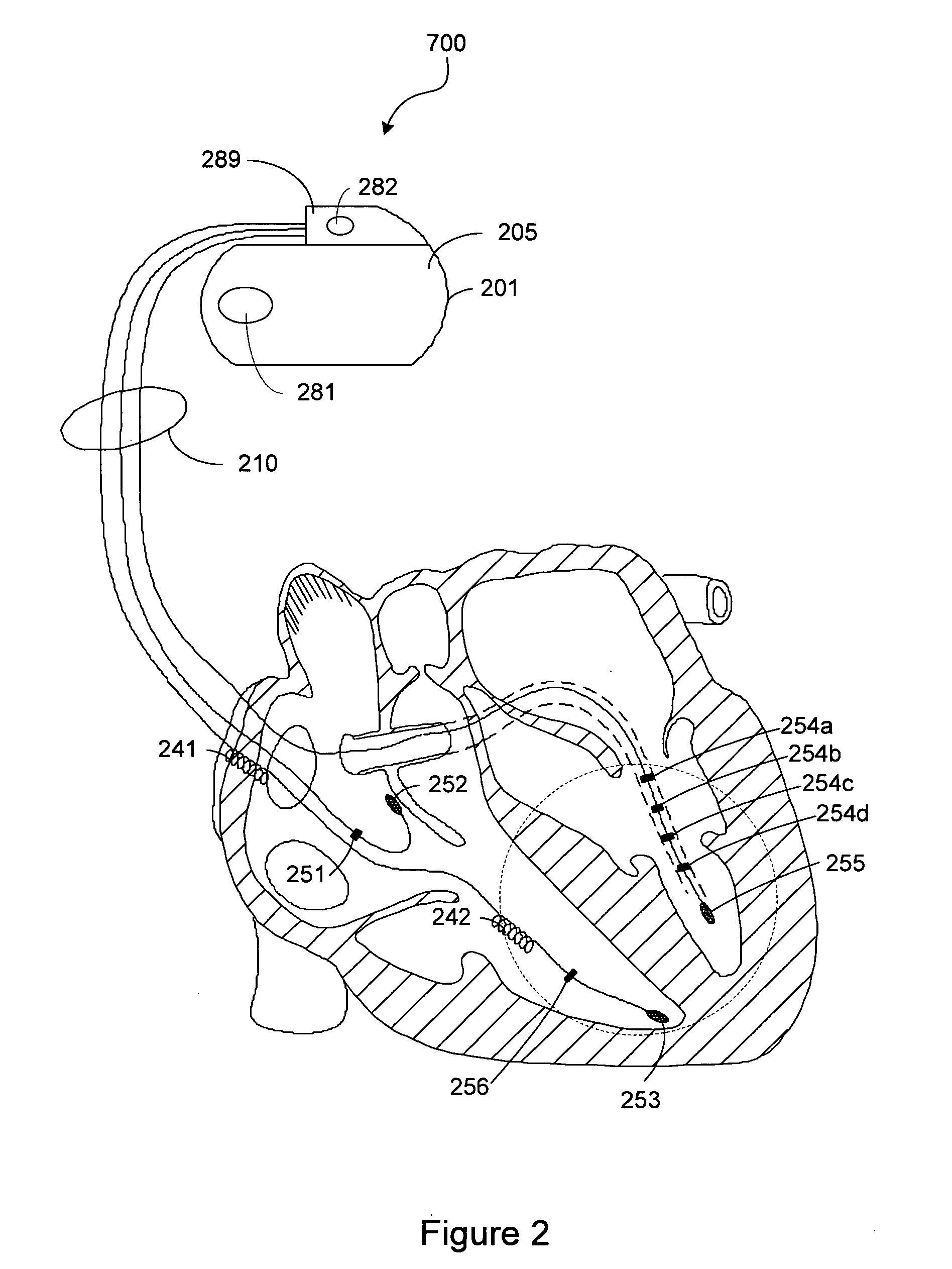 Capture threshold estimation for alternate pacing vectors