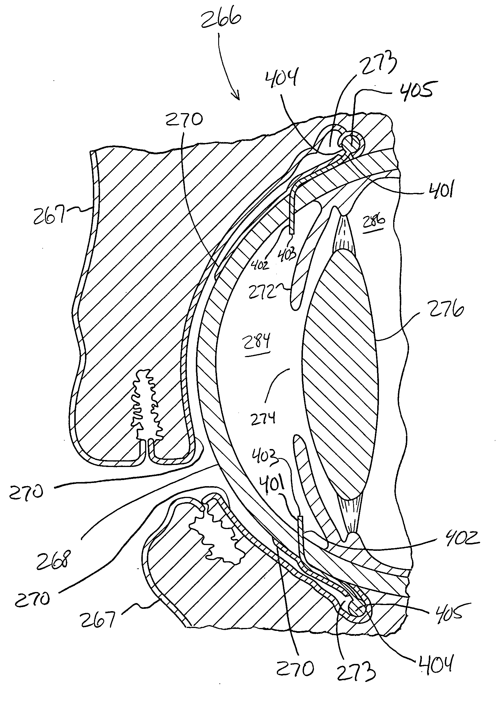 System and method for treating glaucoma