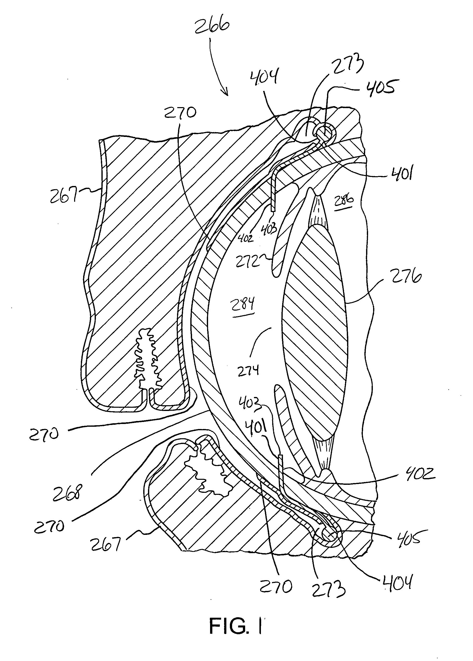 System and method for treating glaucoma