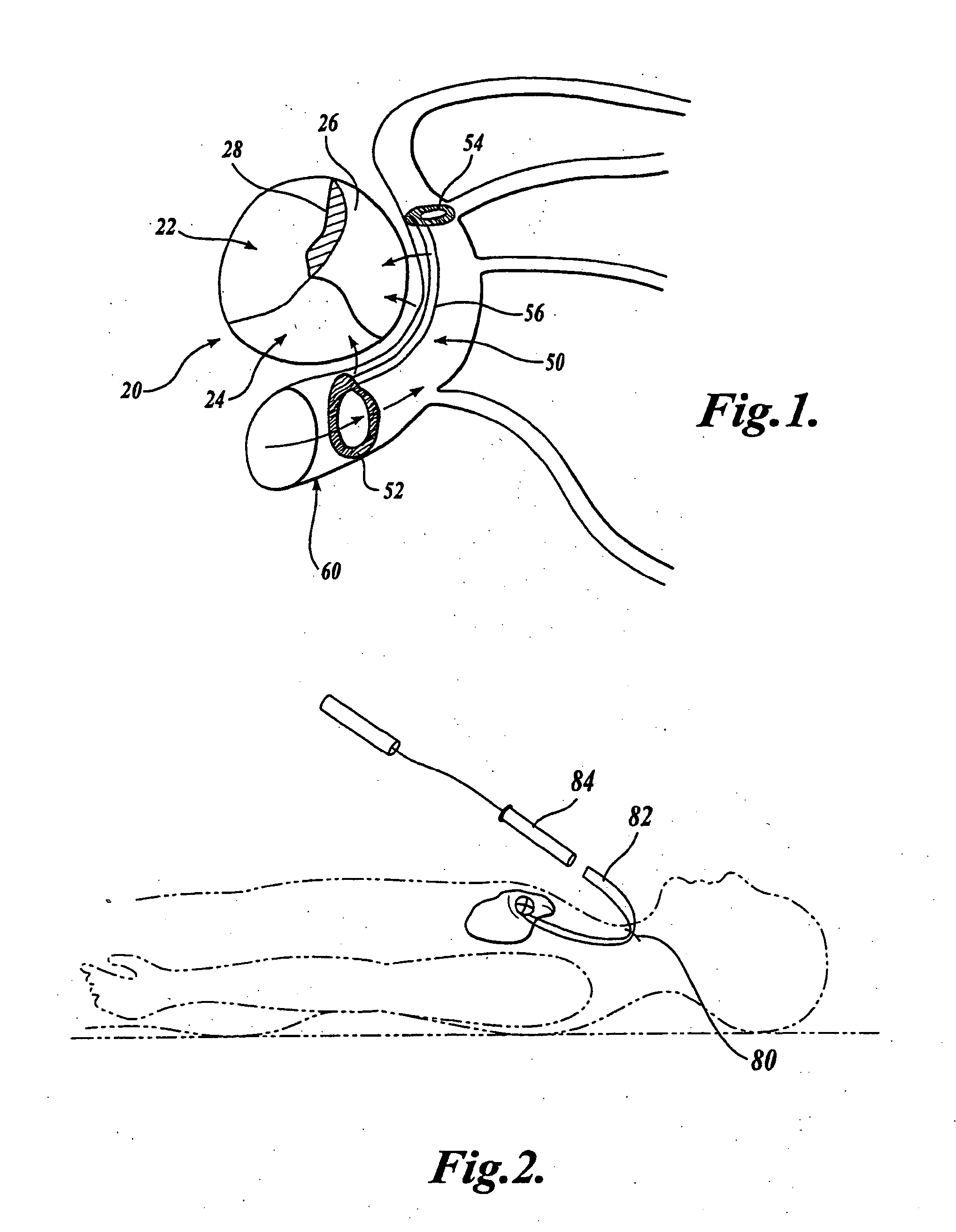 Device and method for modifying the shape of a body organ