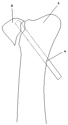 Repositor for tibial plateau splitting fracture bone block