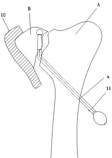 Repositor for tibial plateau splitting fracture bone block