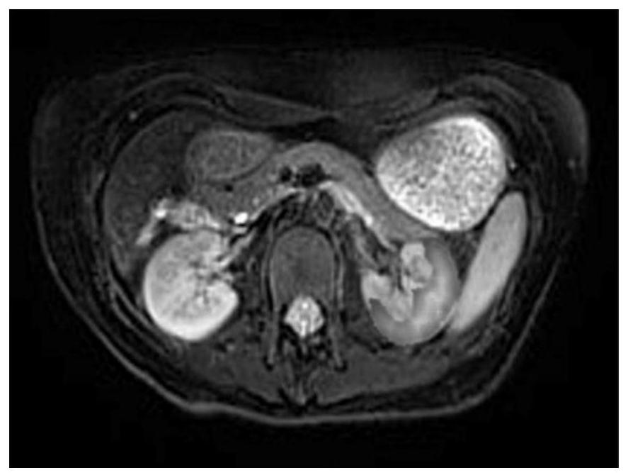 Renal fibrosis evaluation method based on magnetic resonance elastography and serological examination