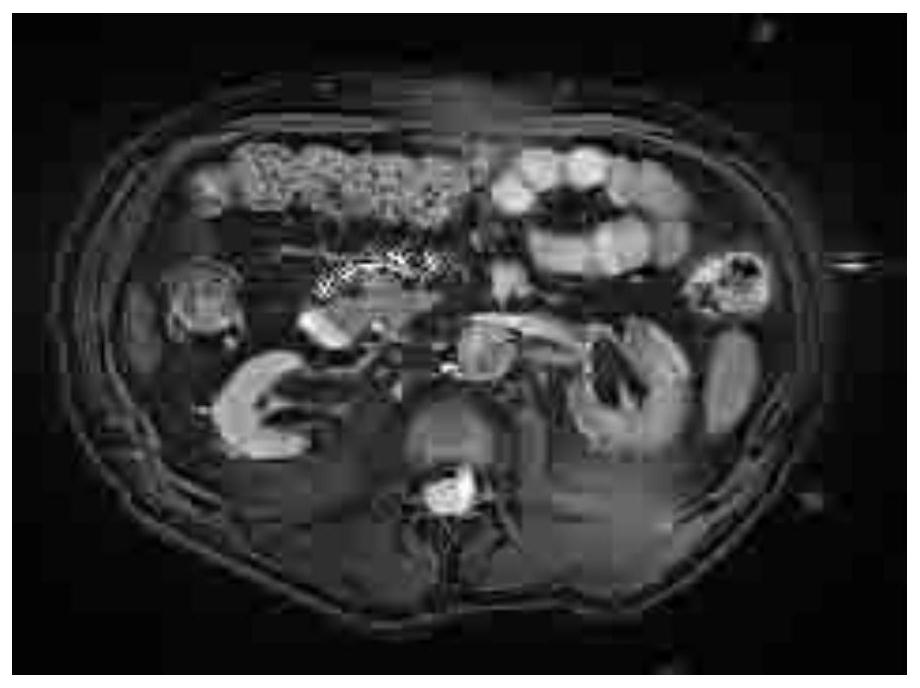 Renal fibrosis evaluation method based on magnetic resonance elastography and serological examination