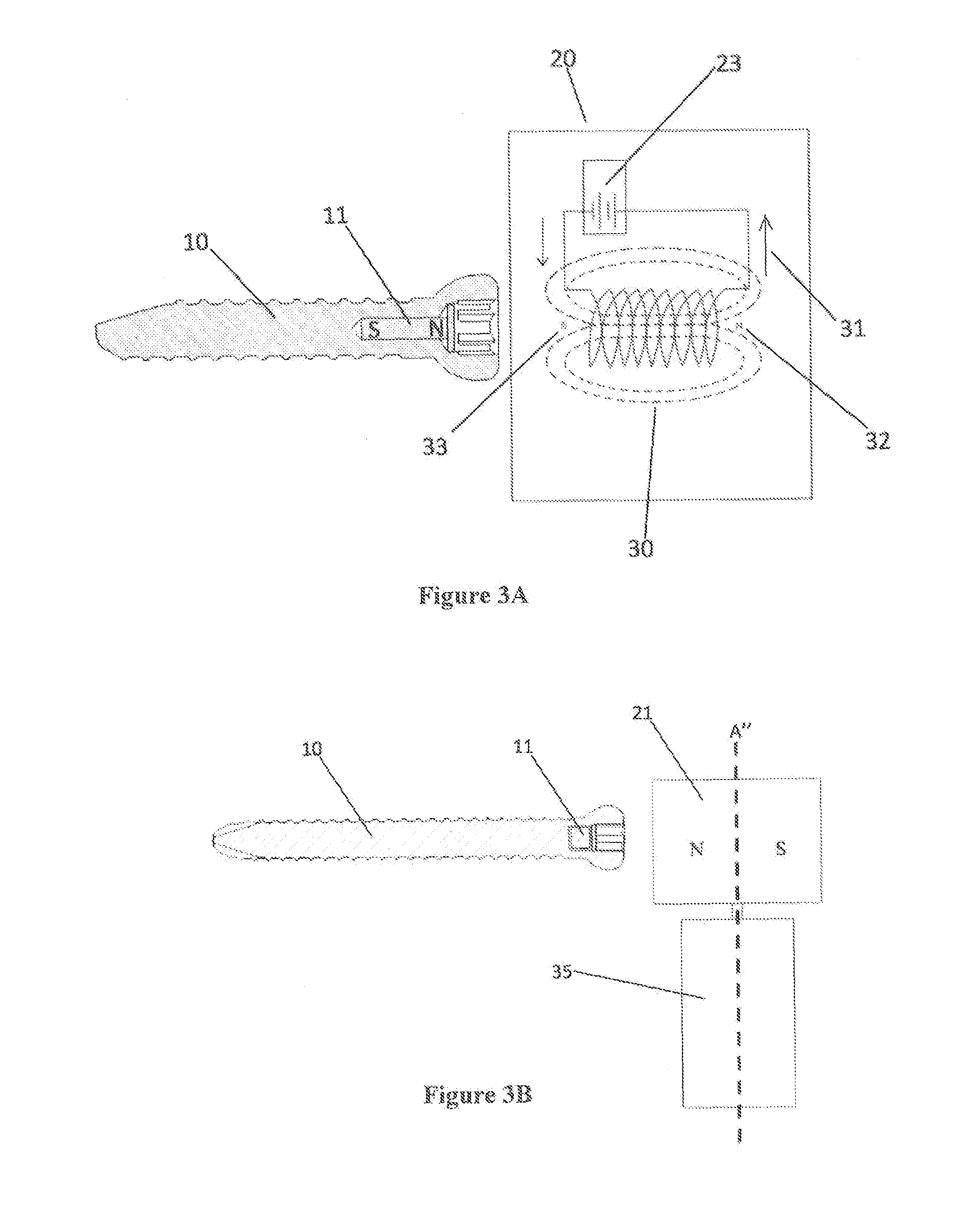 Dynamic force generation for bone repair