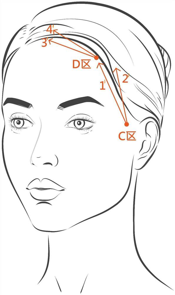 Beauty injection method for lifting, firming and shaping face on hairline