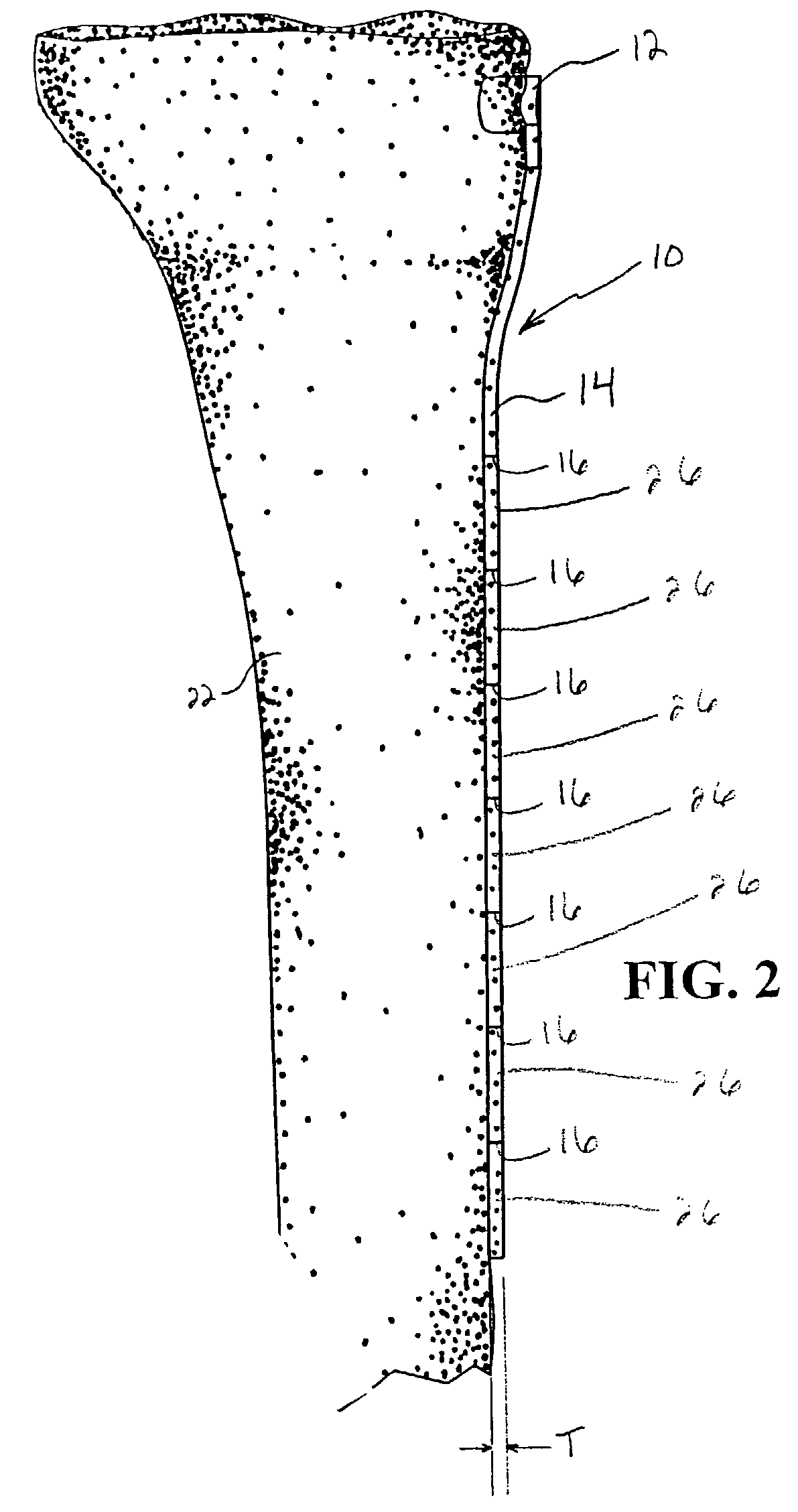 Provisional bone plate