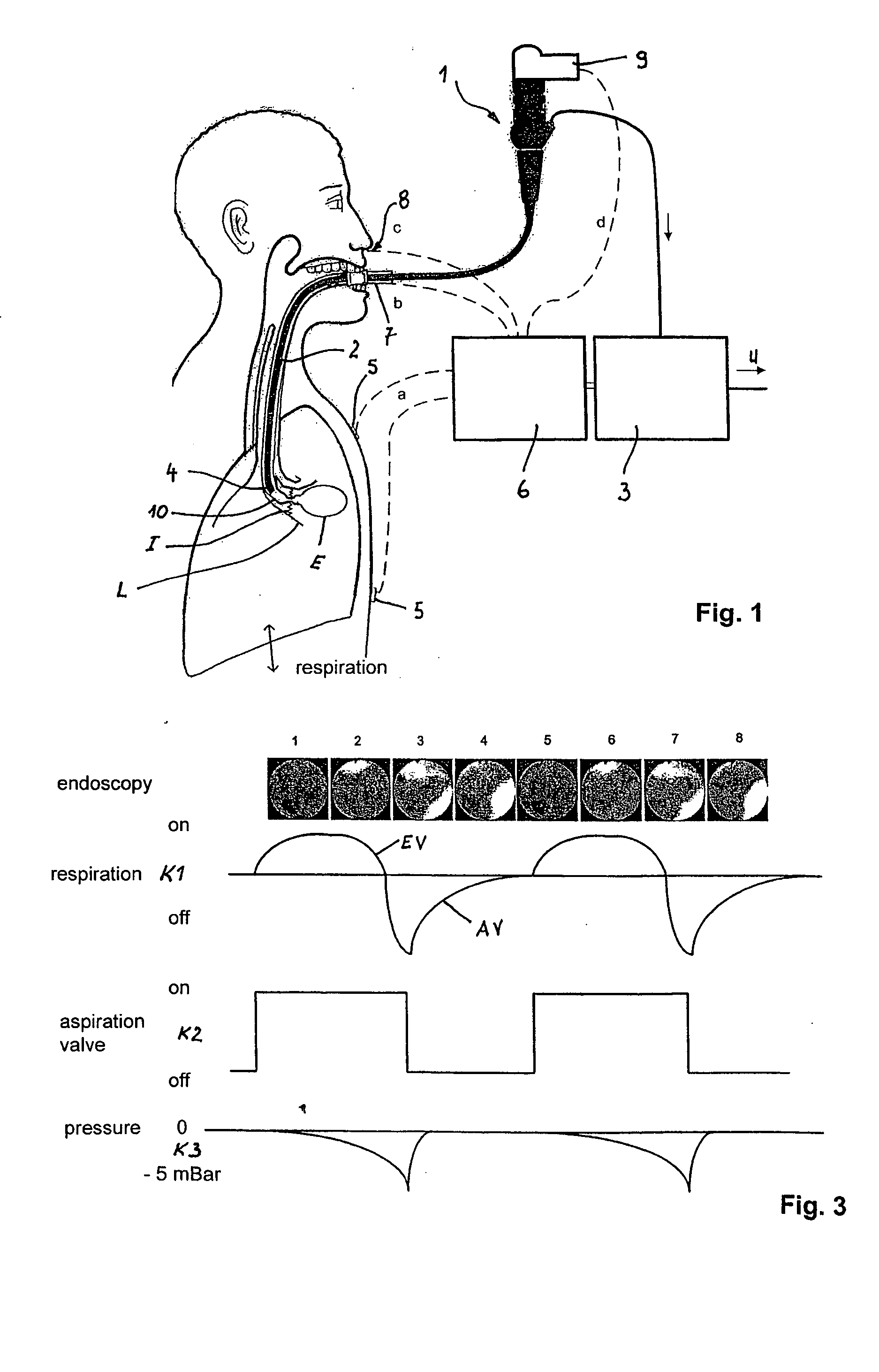 Method and arrangement for reducing the volume of a lung