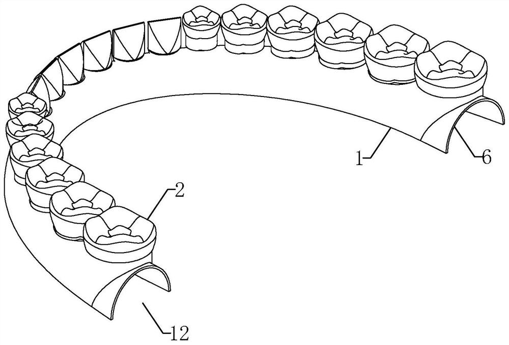 a removable denture