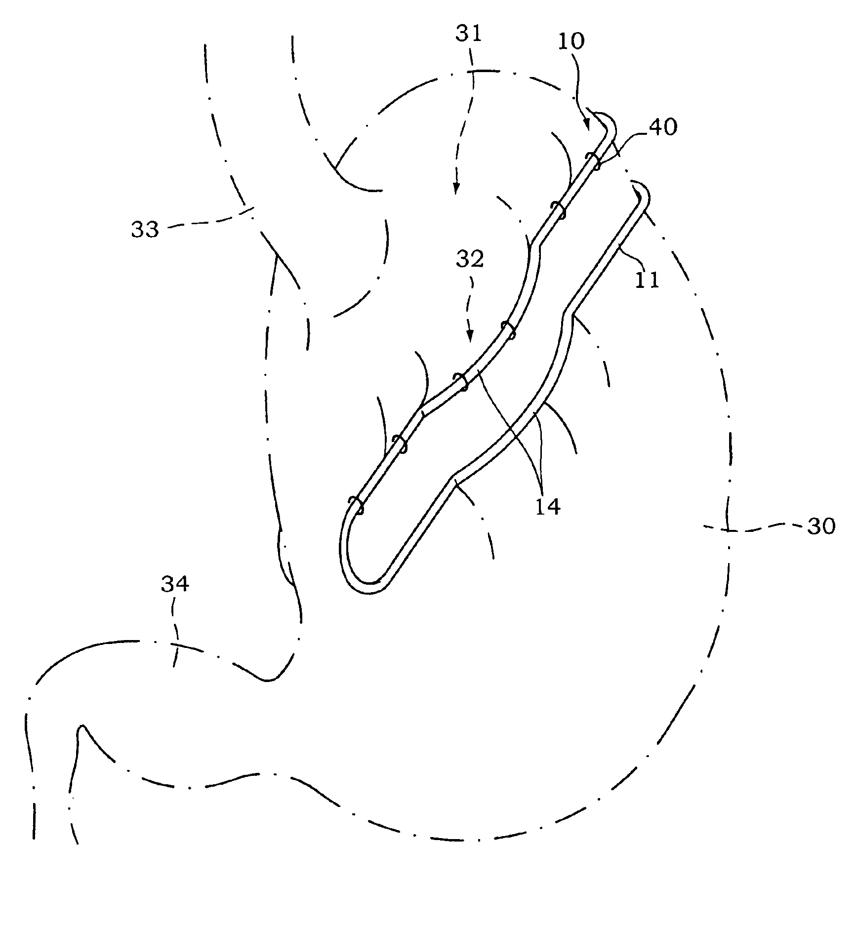 Gastric partition clip