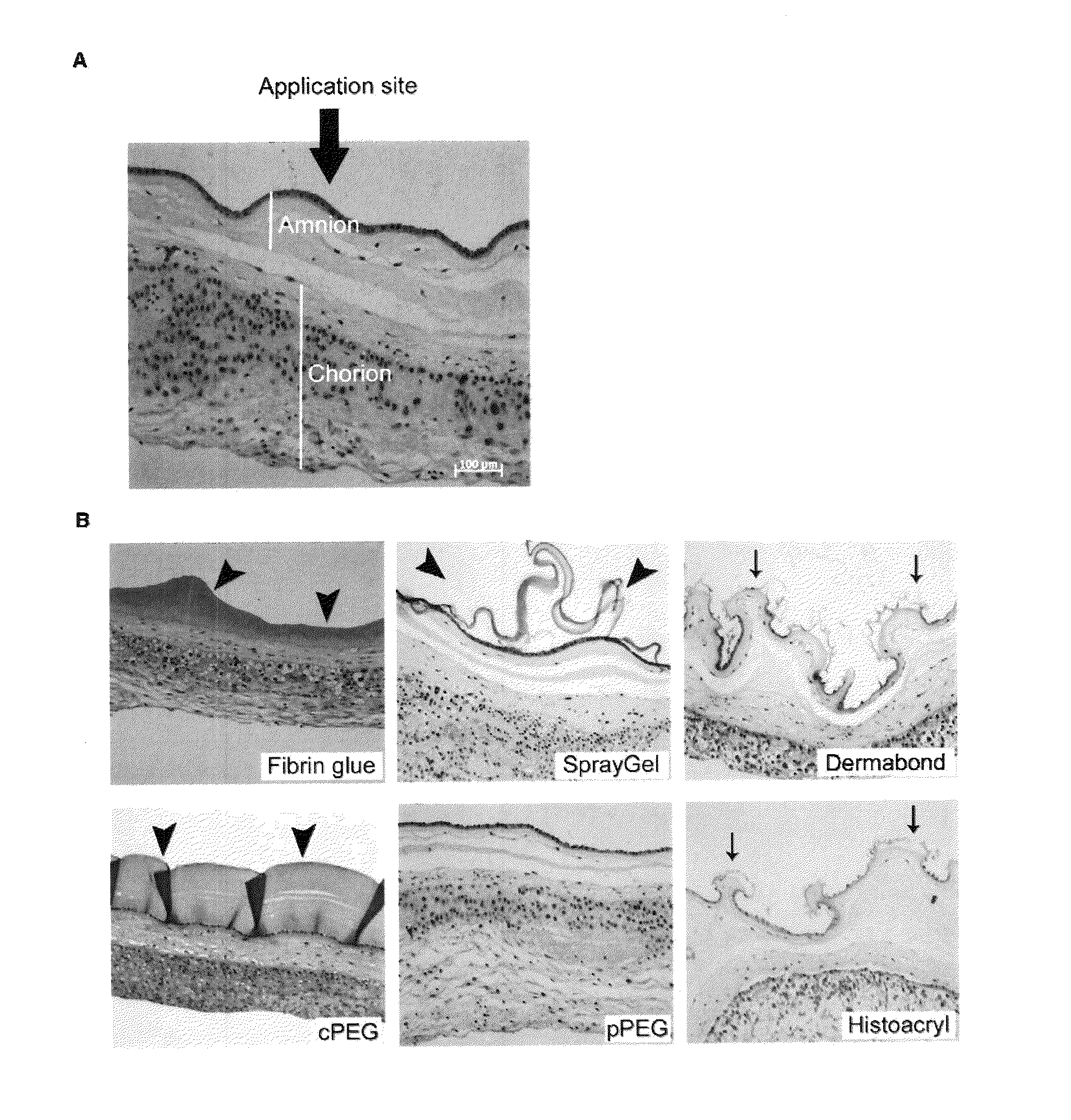 Sealants for Fetal Membrane Repair