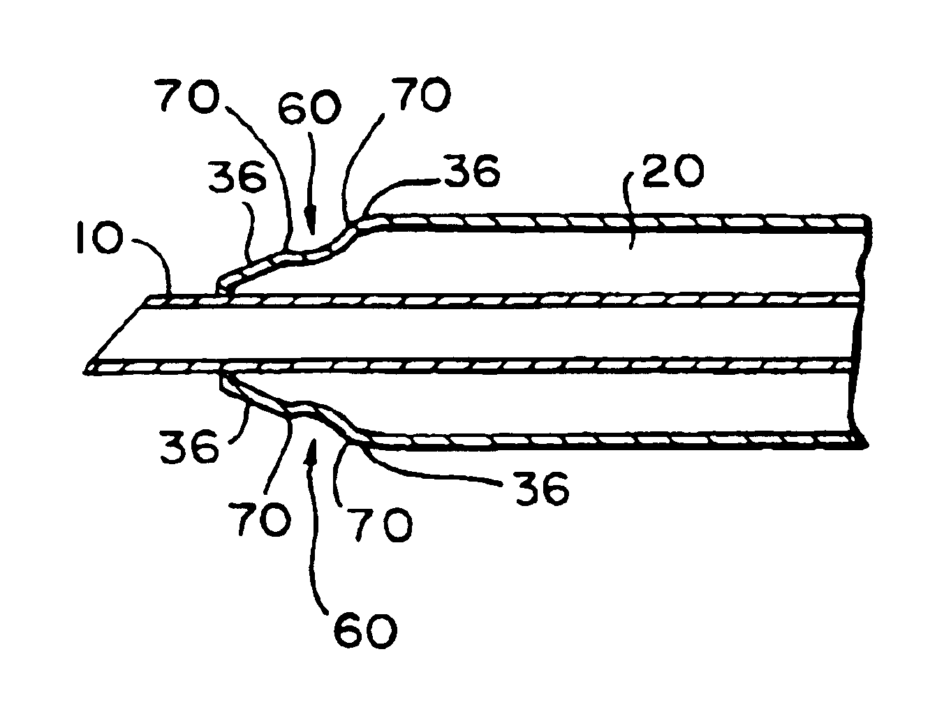 Tapered infusion sleeve portal