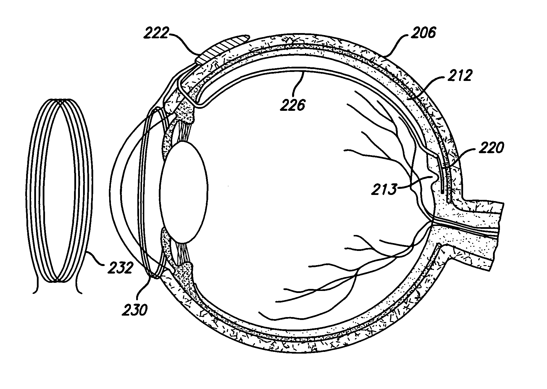 Transretinal implant and method of manufacture