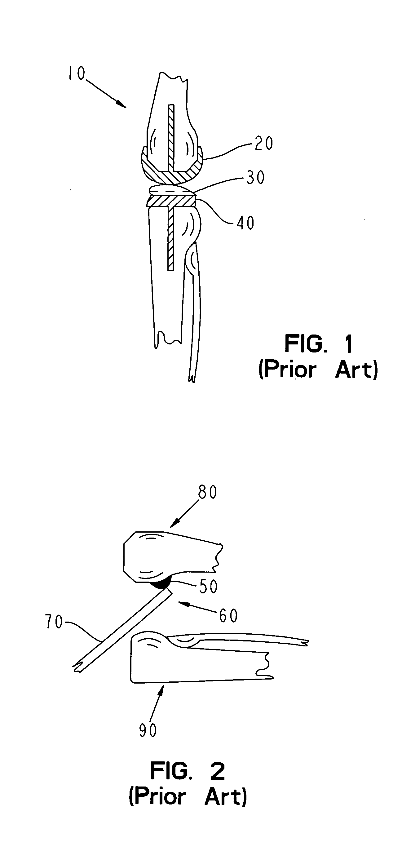 Guided osteotomes