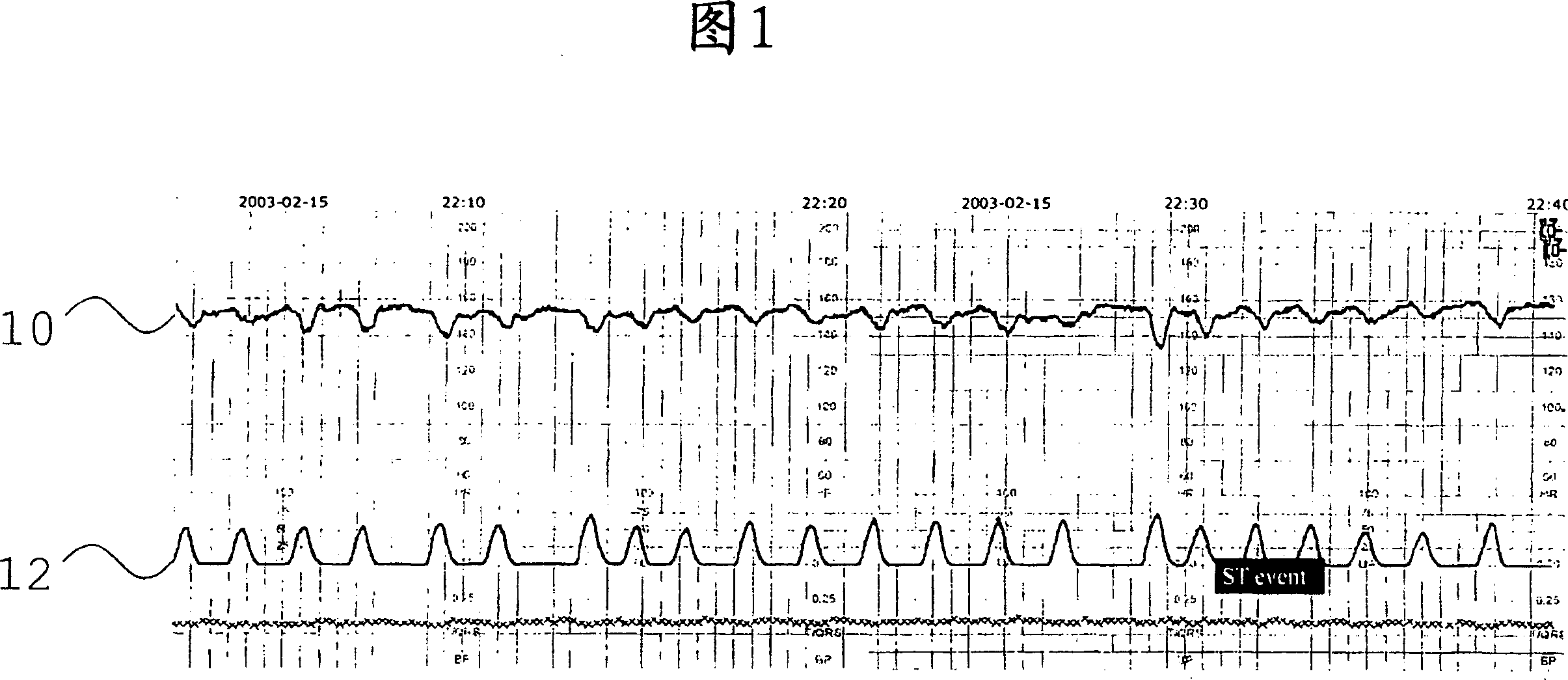 Assessment of fetal reactivity by fetal heart rate analysis