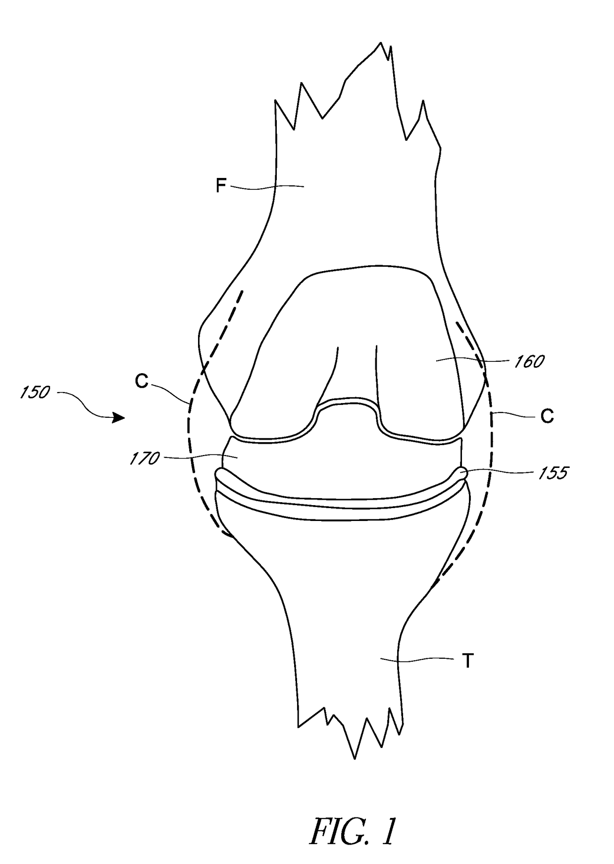 Methods for balancing a joint during a surgical procedure