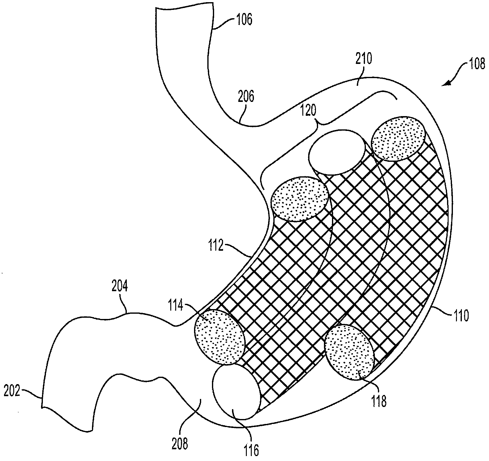 Method and apparatus for treating obesity and controlling weight gain using self-expanding intragastric devices