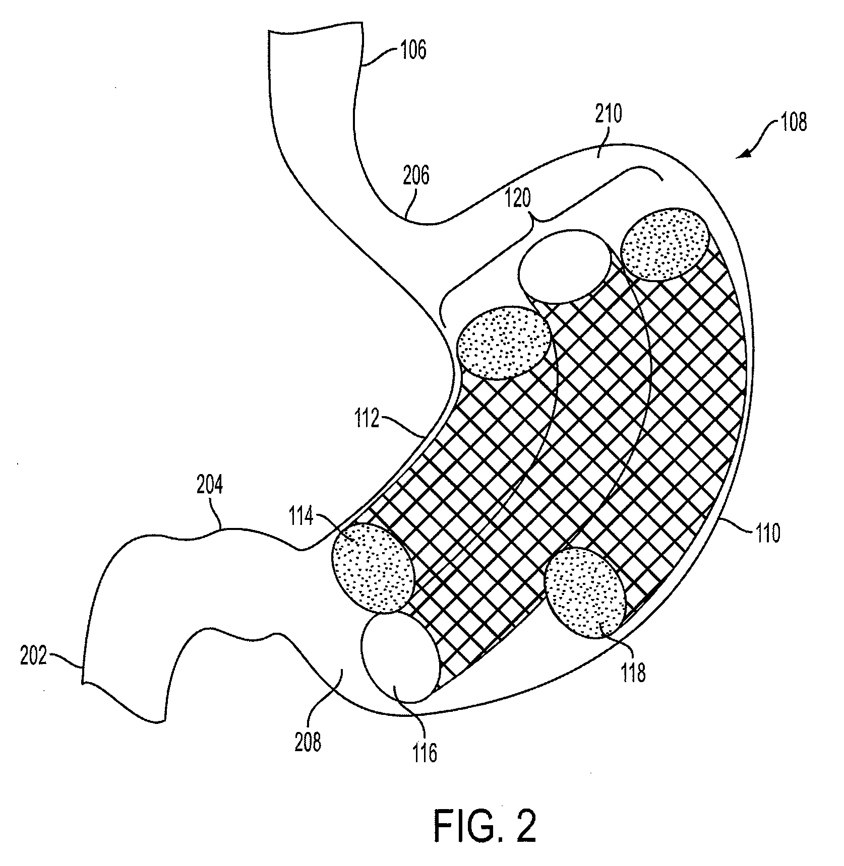 Method and apparatus for treating obesity and controlling weight gain using self-expanding intragastric devices