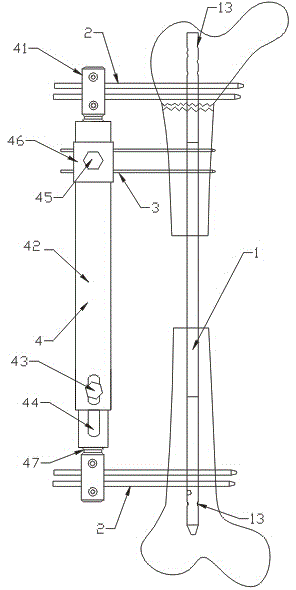 Bone transport apparatus for treatment of large segmental defect of femur