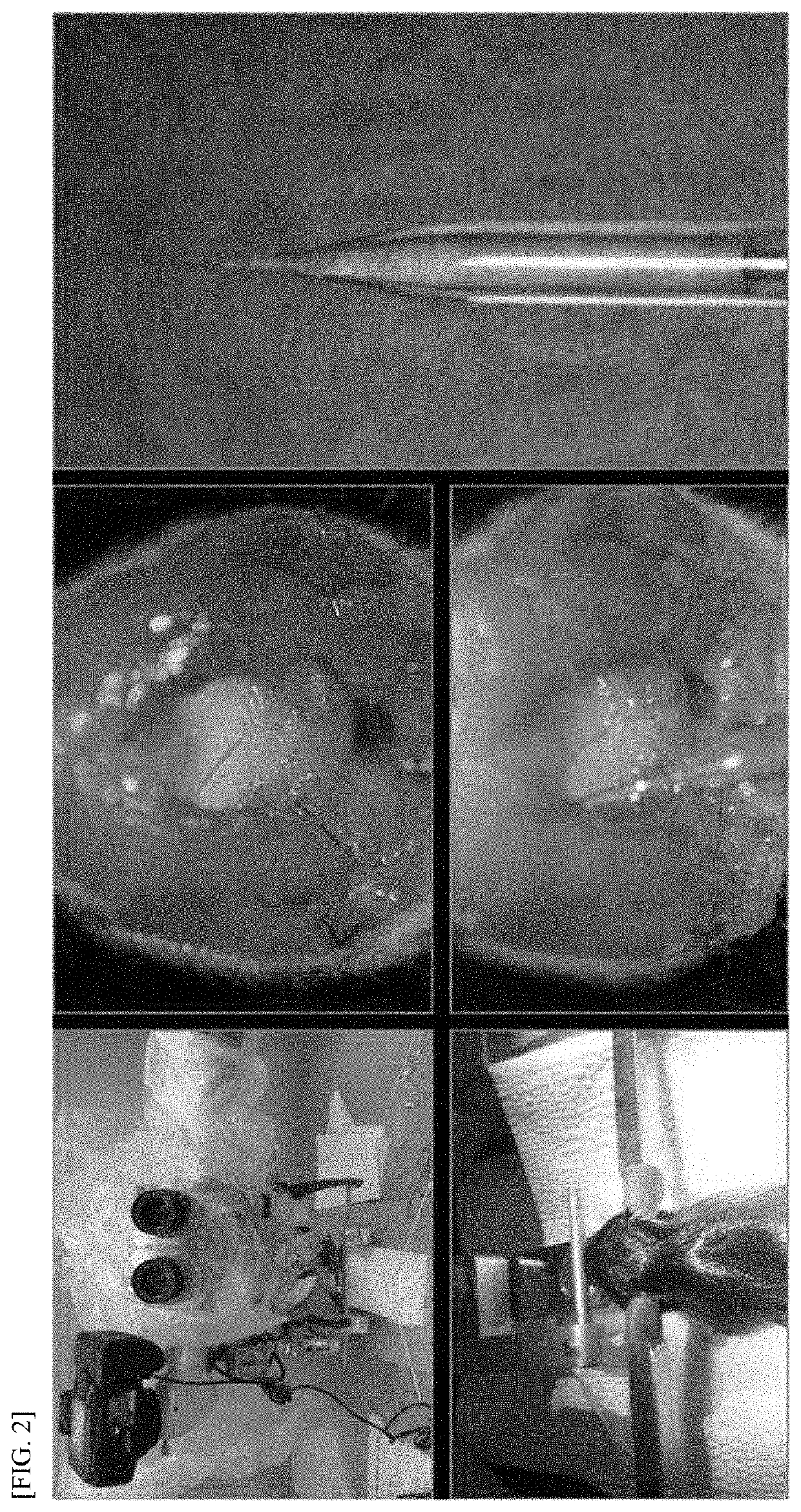 Method and composition for treating hunter syndrome through cerebral lateral ventricle administration