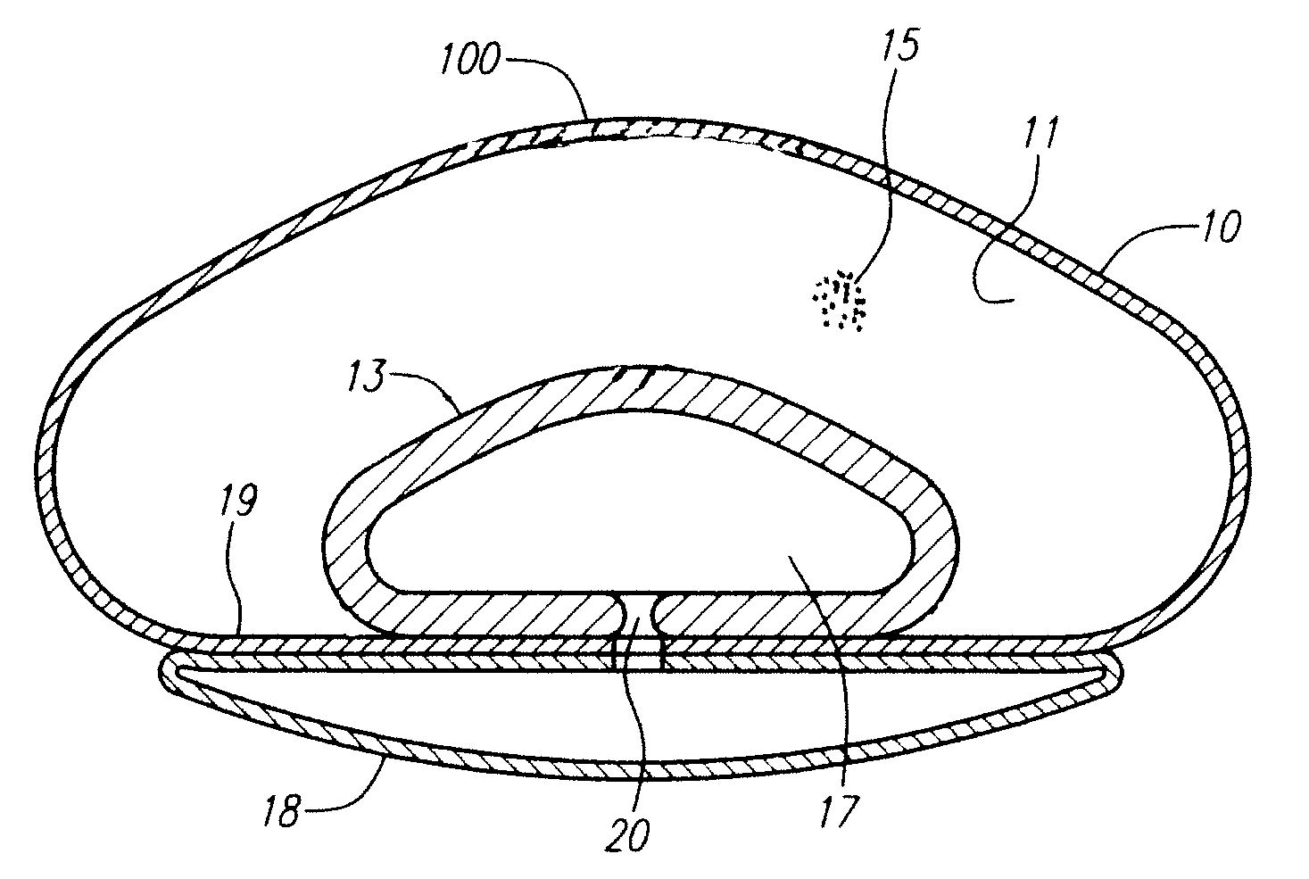 Modulating buttress saline mammary prosthesis