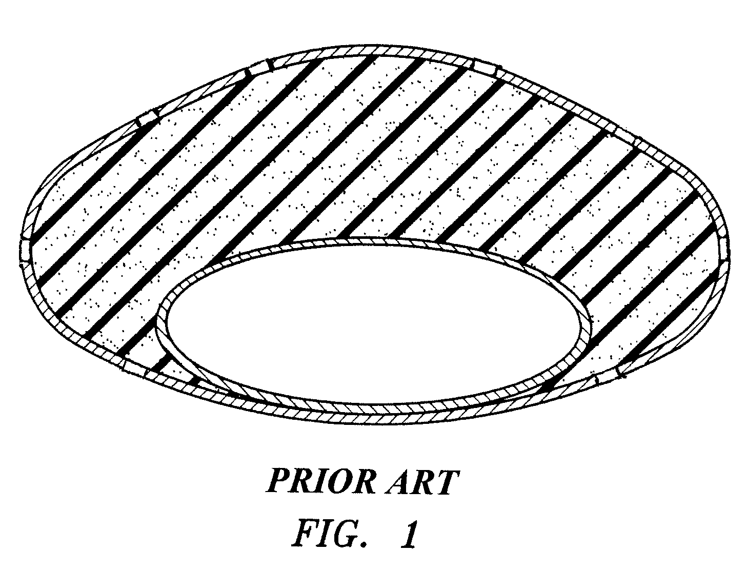 Modulating buttress saline mammary prosthesis