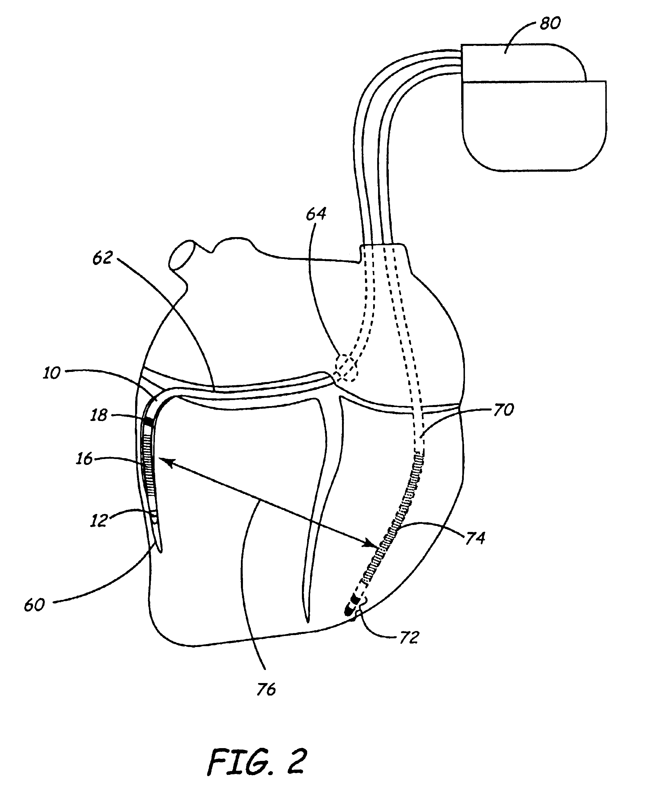 Connection system for a multi-polar lead