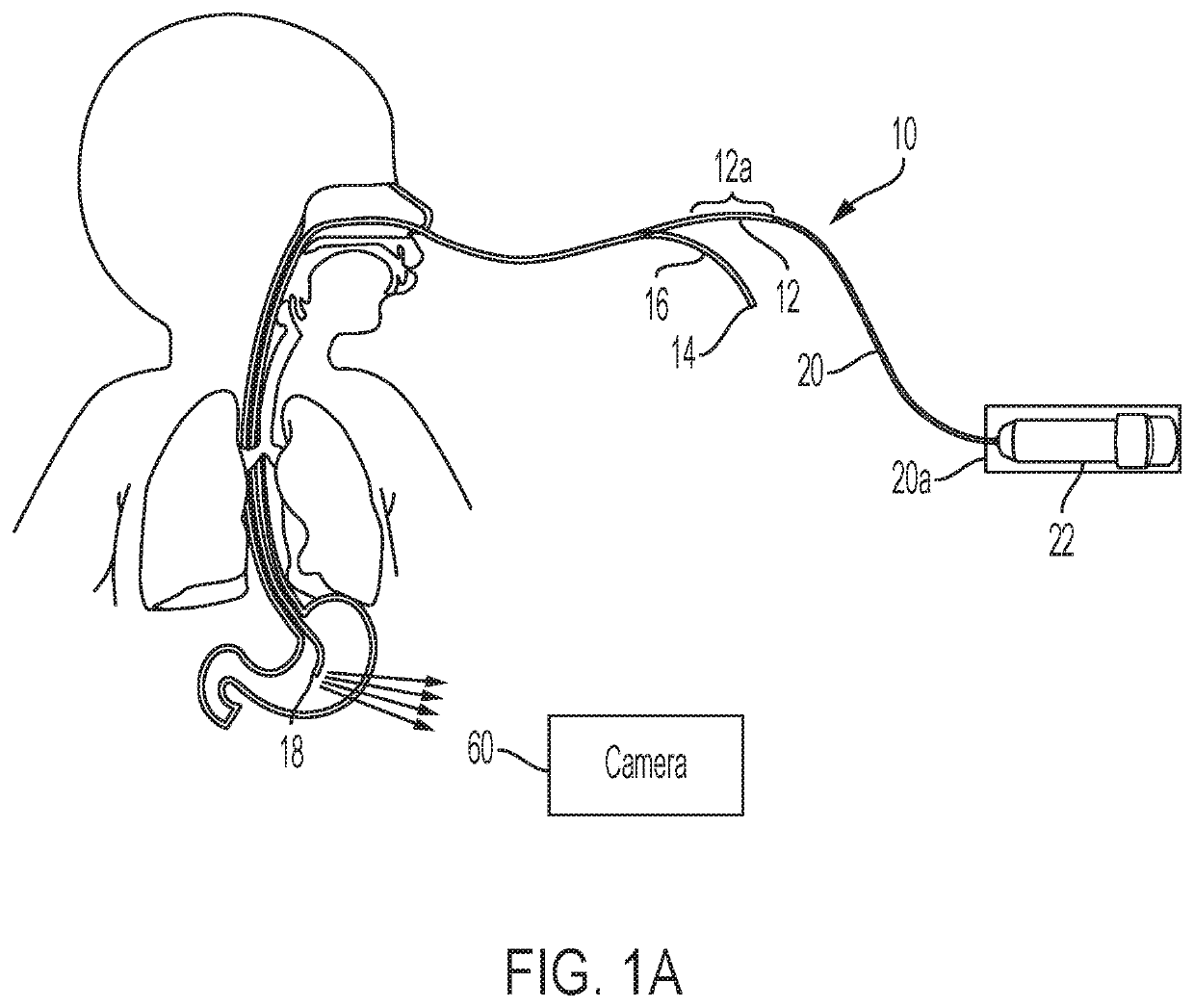 Positioning a tube in a lumen via transillumination