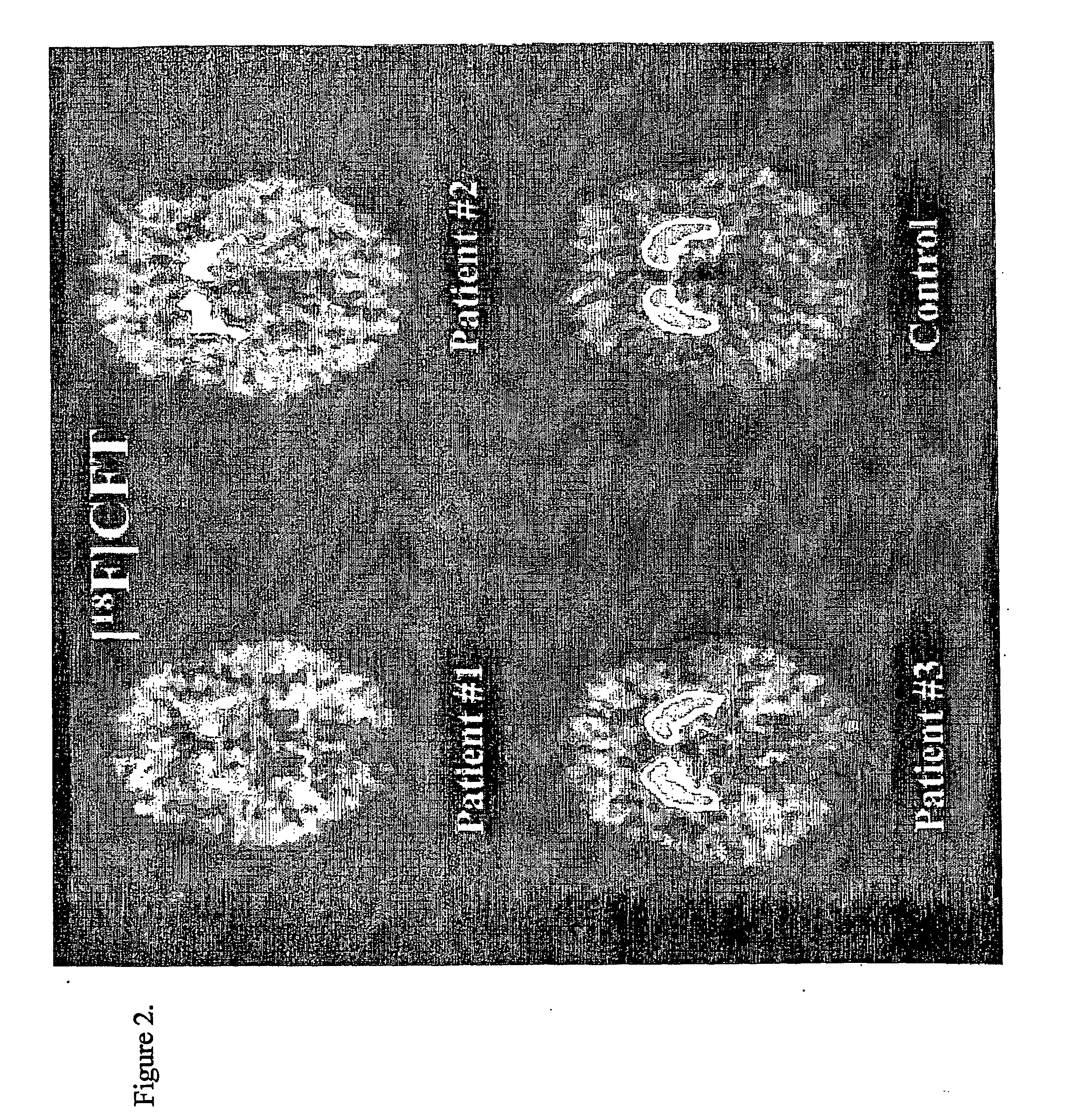 Diagnosis and Prediction of Parkinson's Disease