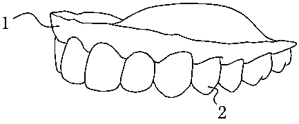 Manufacturing method of orthodontic implant anchorage guide plate and orthodontic implant anchorage guide plate