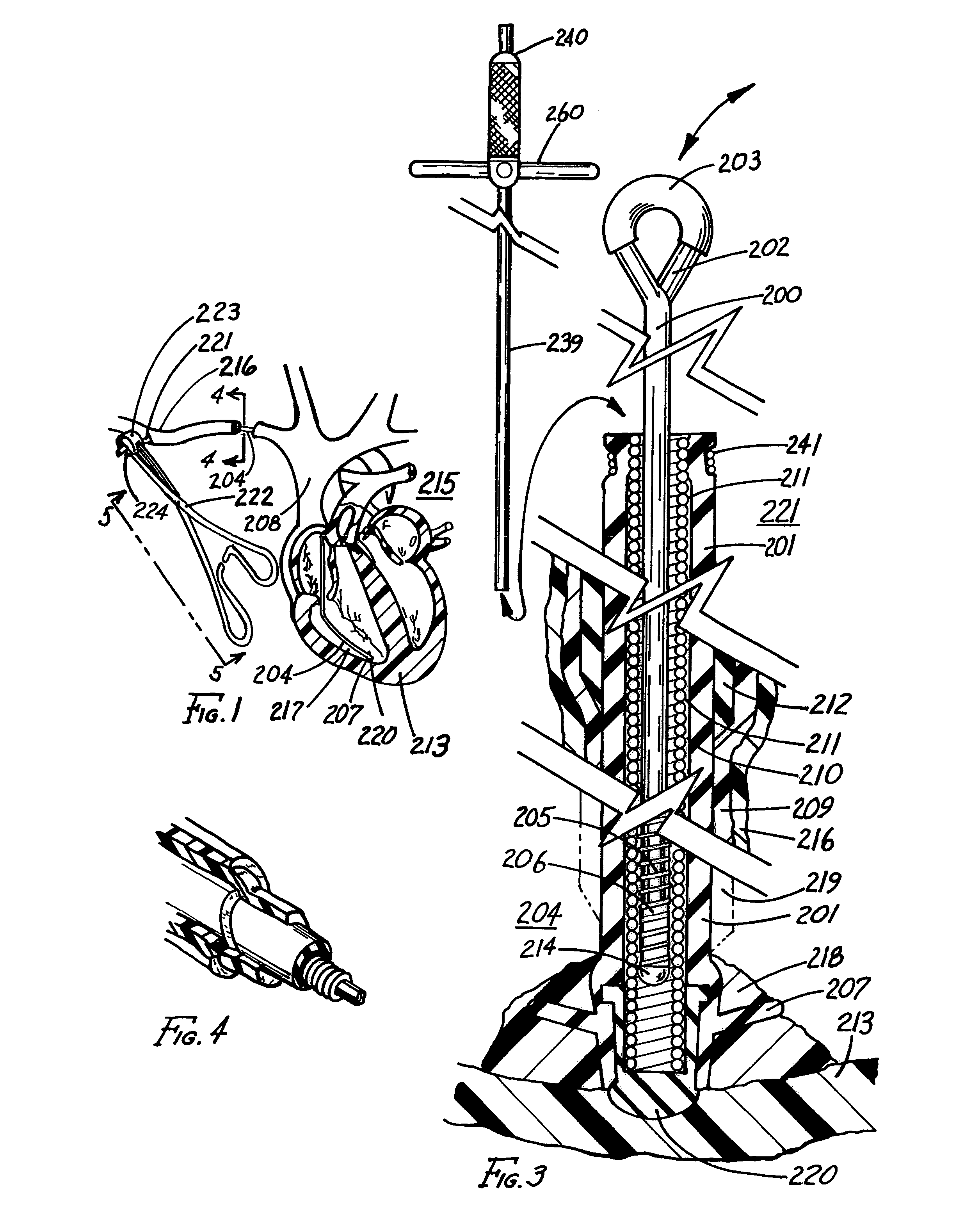 Method of removing an elongated structure implanted in biological tissue