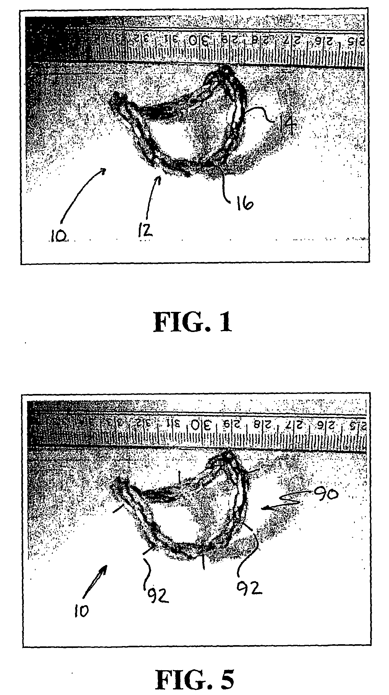 Annuloplasty chain