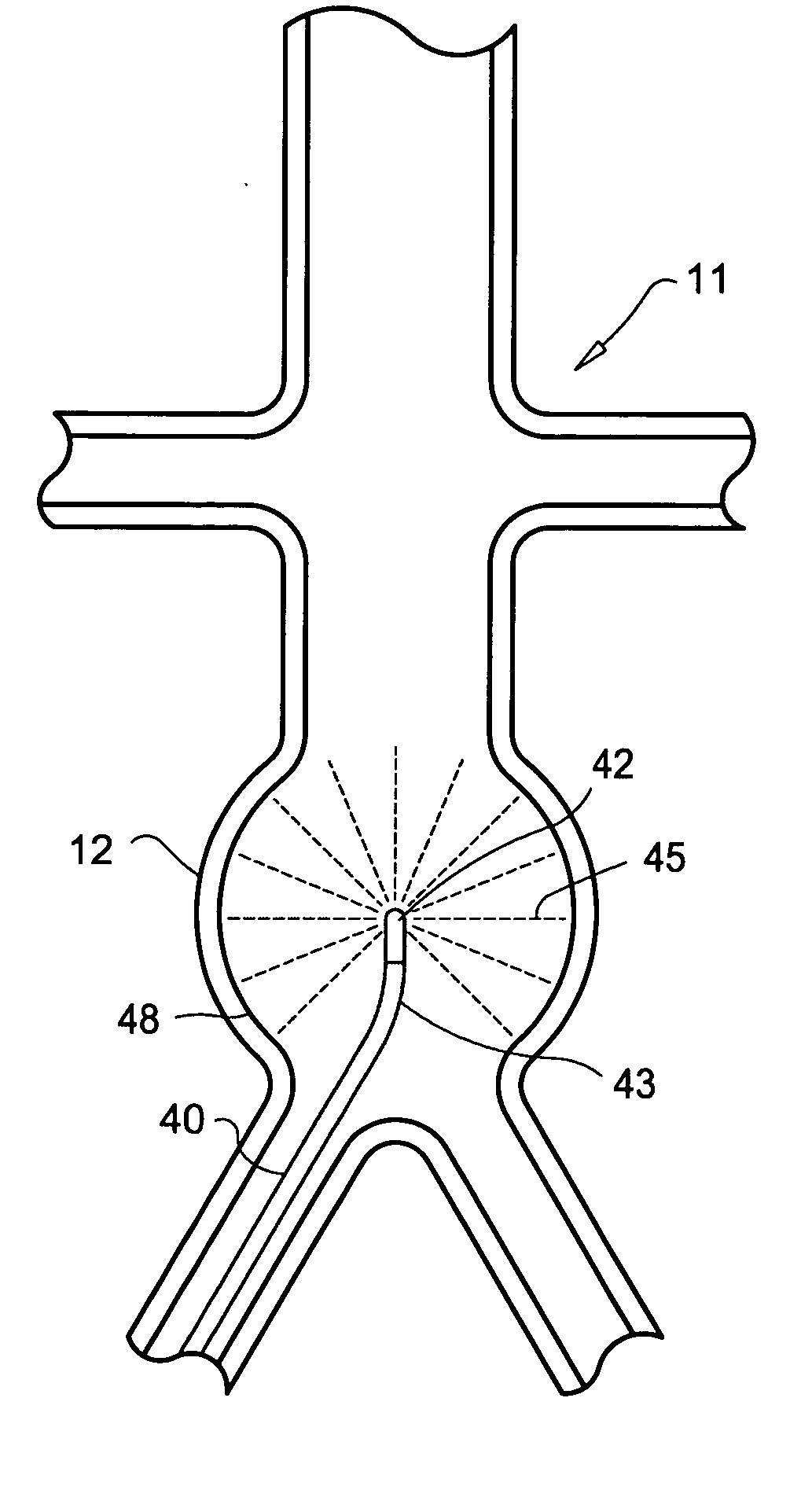 Method for treatment of aneurysms