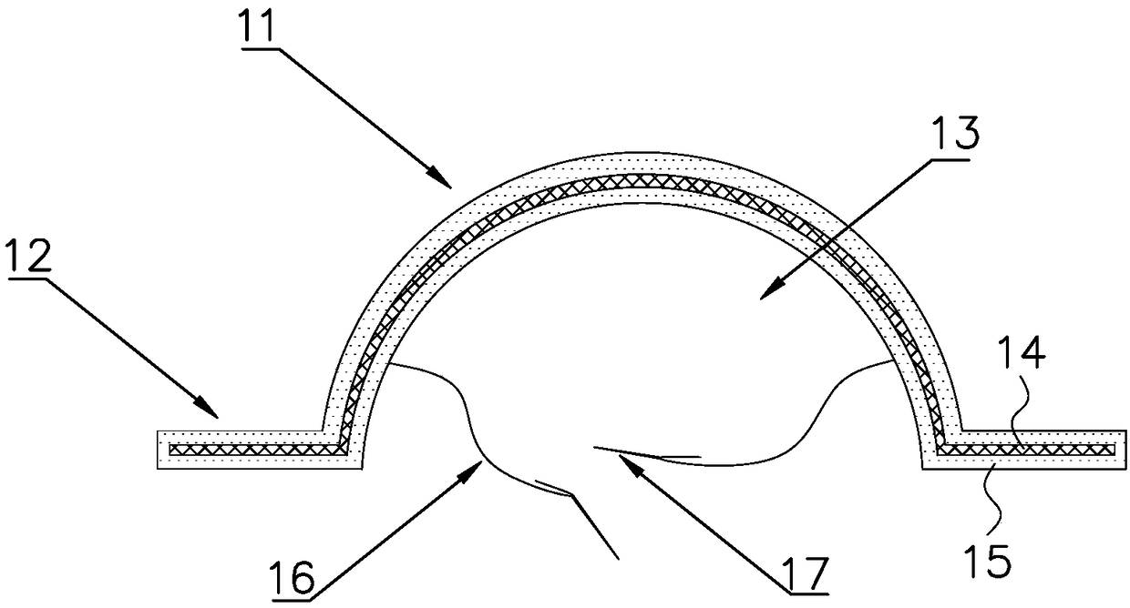 Protection system for blood vessels and nerves in post-traumatic local exposed bone regions