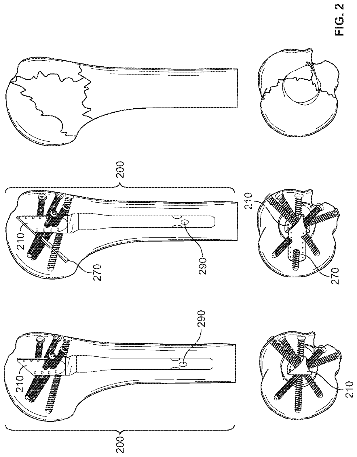 Platform fracture fixation implants