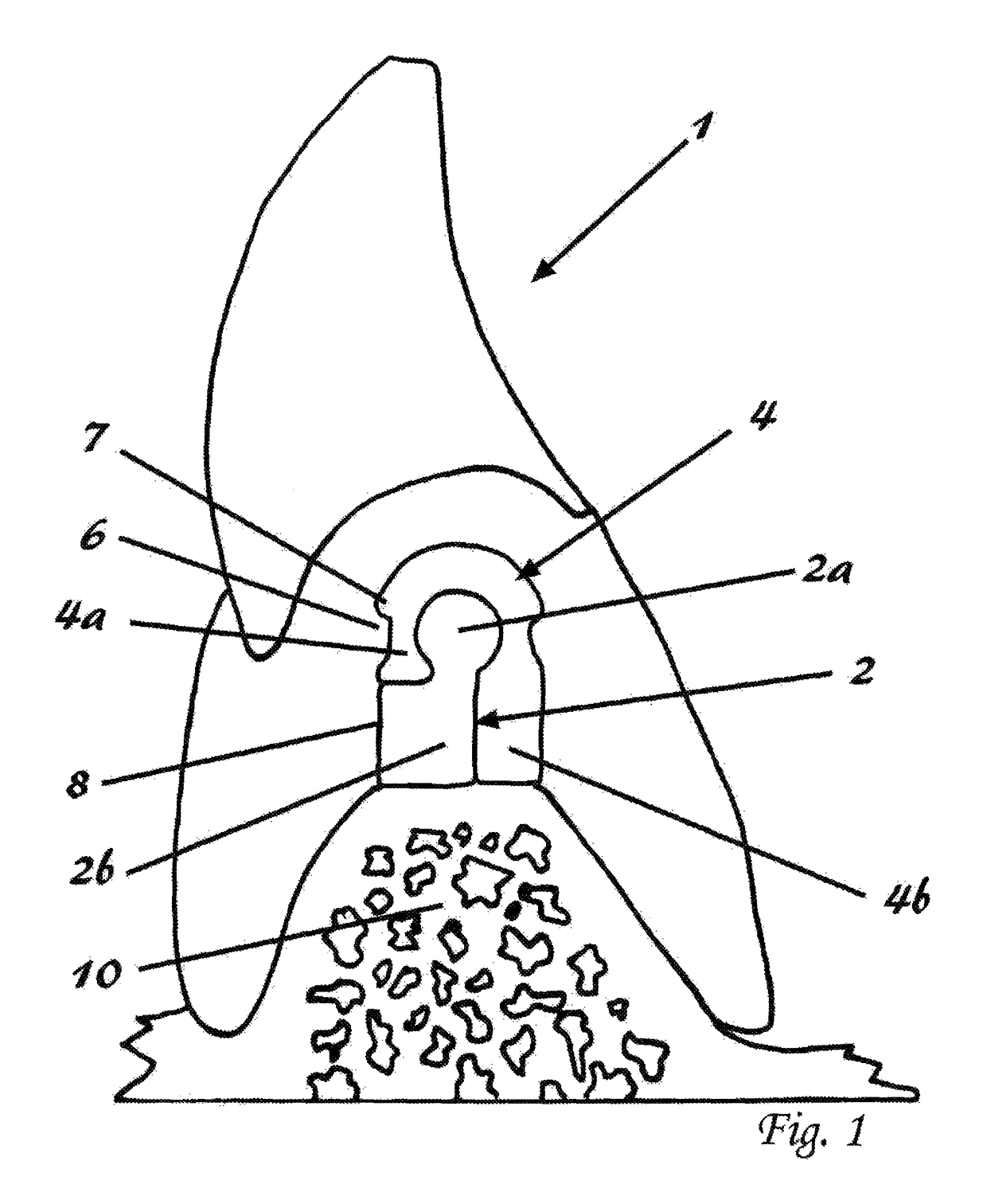 Precision attachment system with indirect retainer