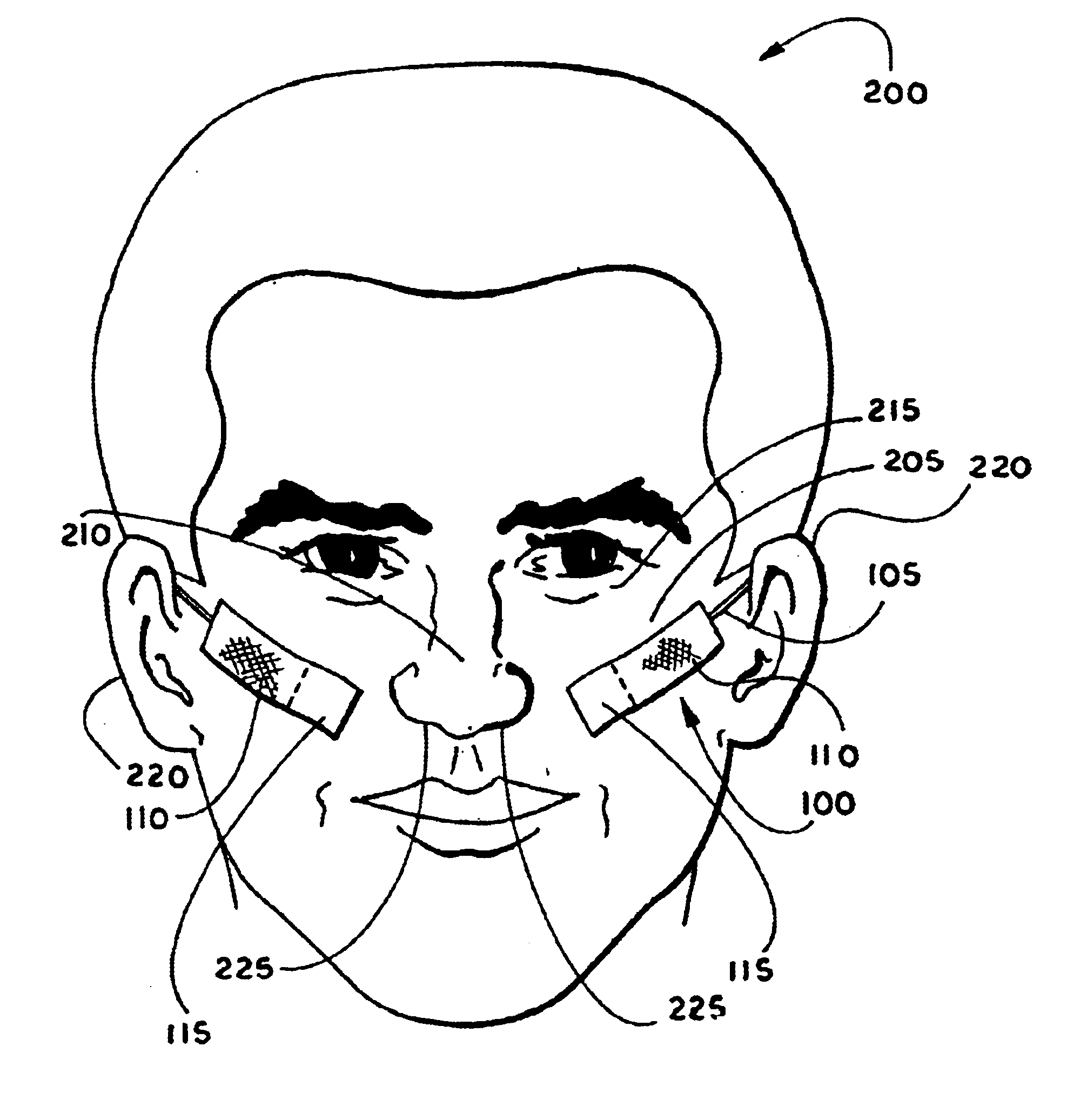 Band nasal dilator