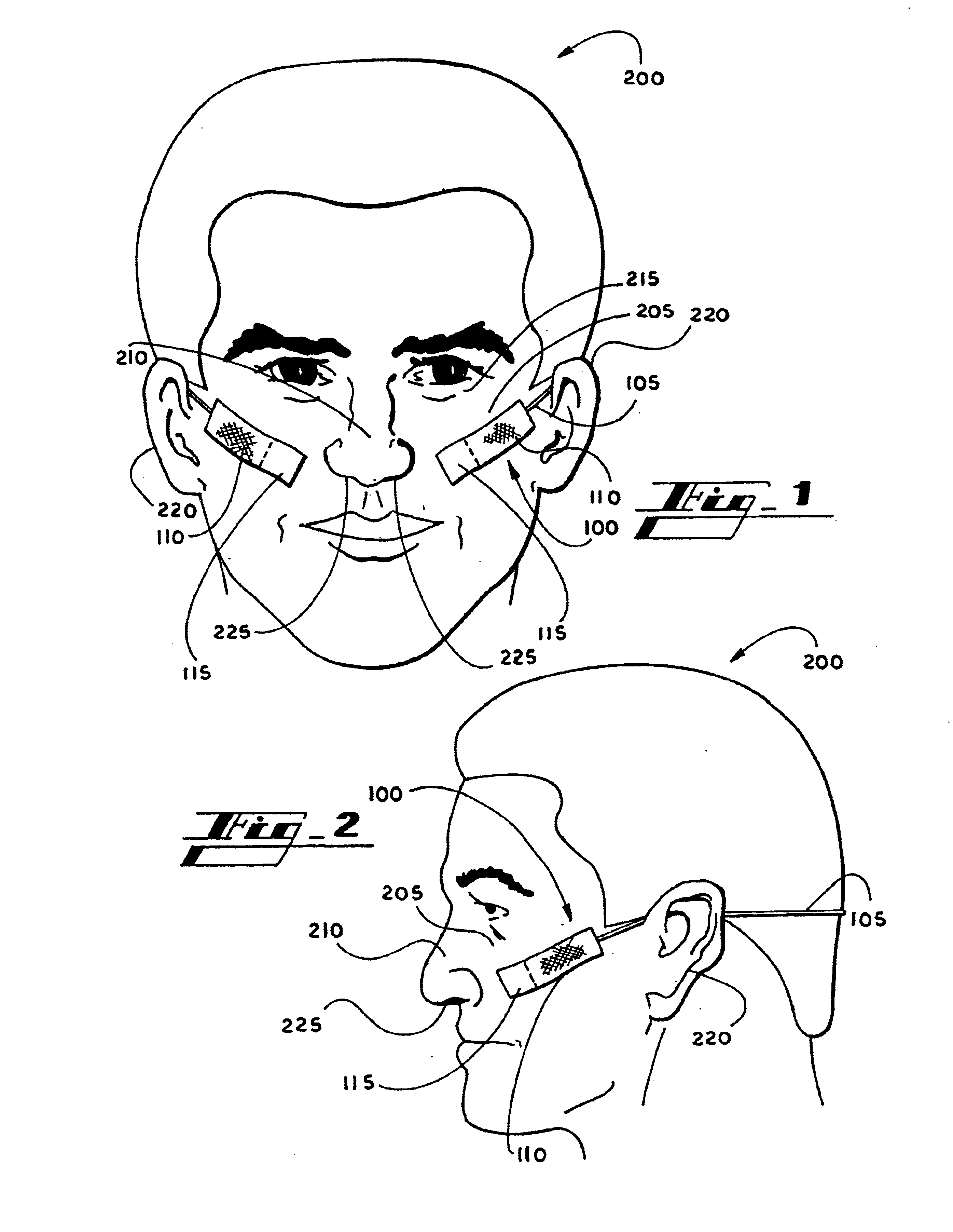 Band nasal dilator