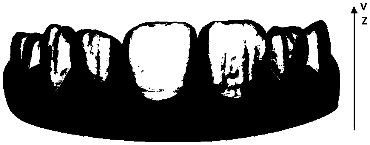 Automatic tooth undercut filling printing method based on tooth feature points