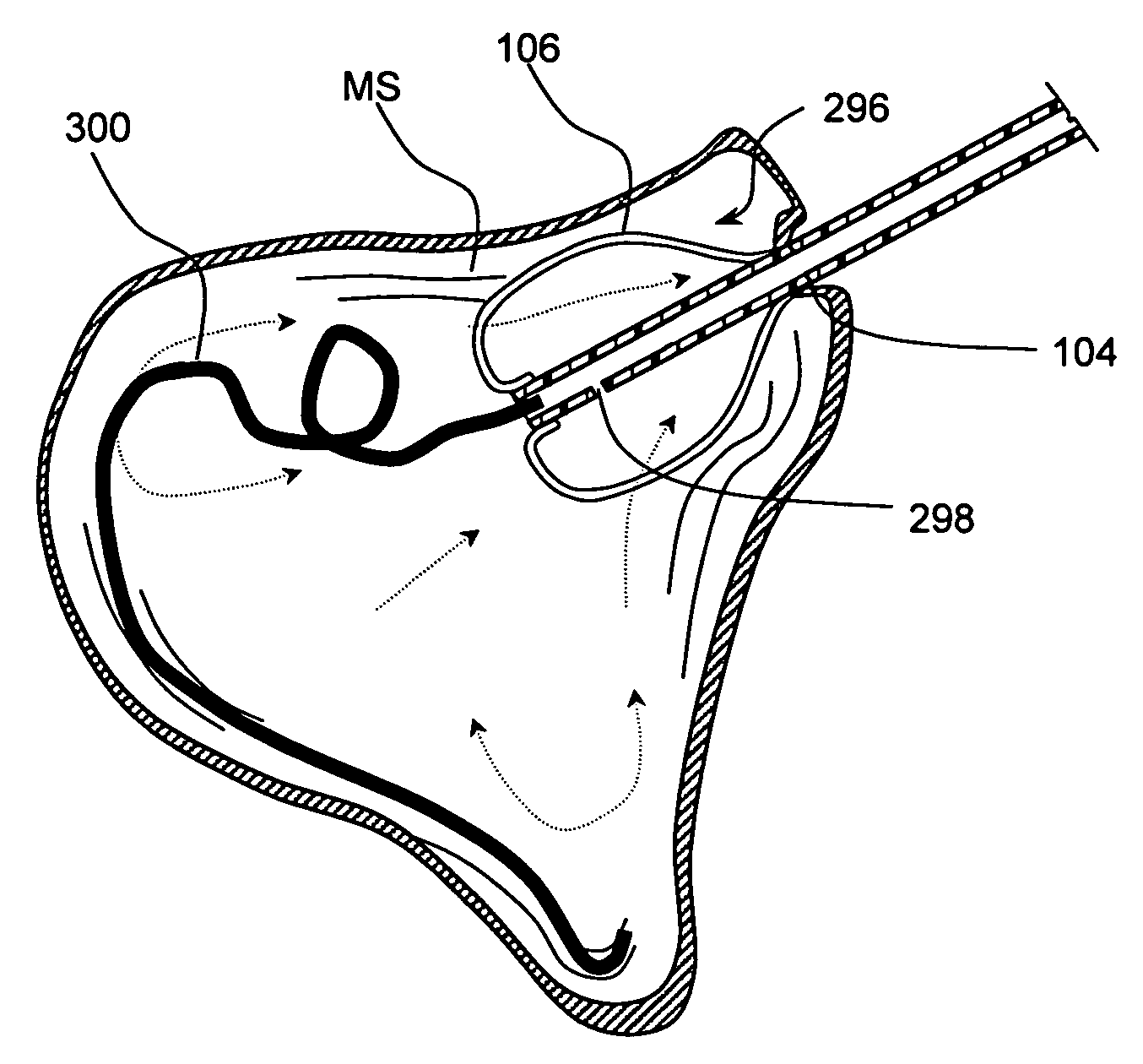 Devices and methods for delivering therapeutic substances for the treatment of sinusitis and other disorders