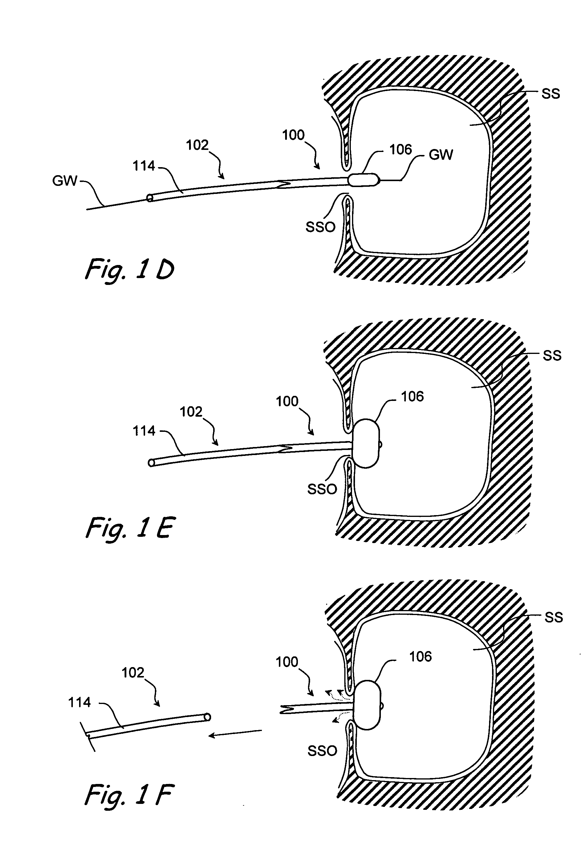 Devices and methods for delivering therapeutic substances for the treatment of sinusitis and other disorders