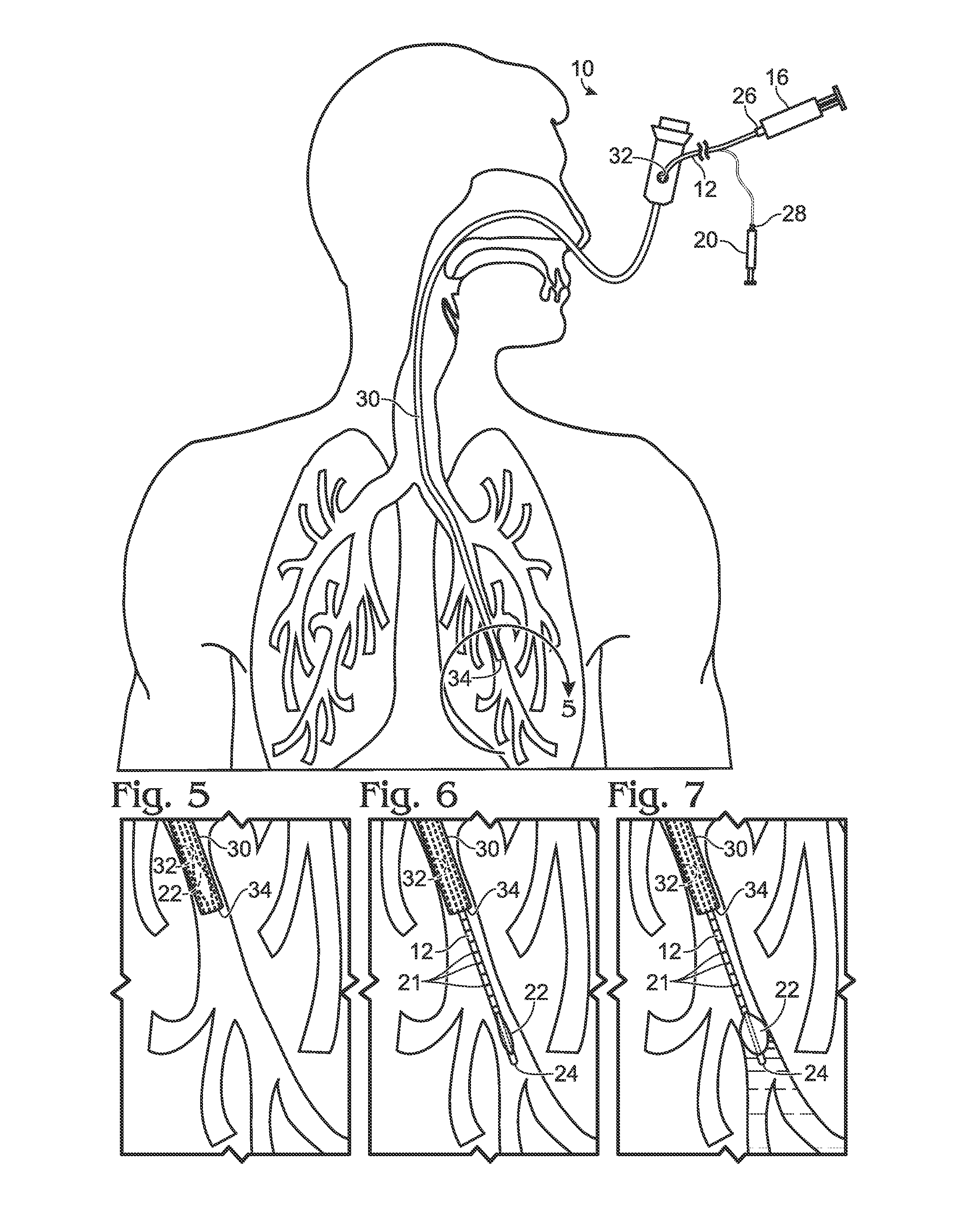 Medical systems and methods