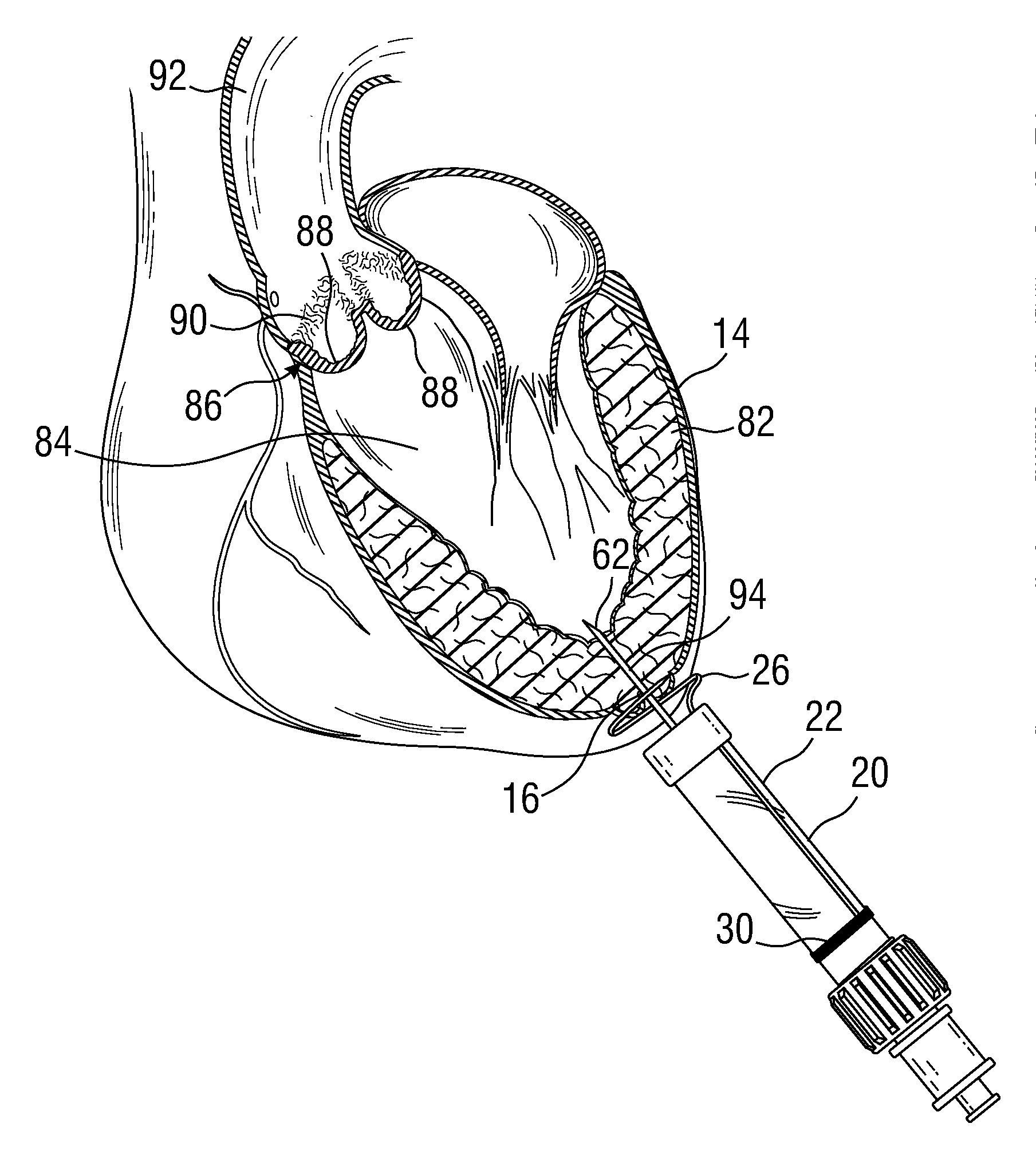 Surgical stabilizer and closure system