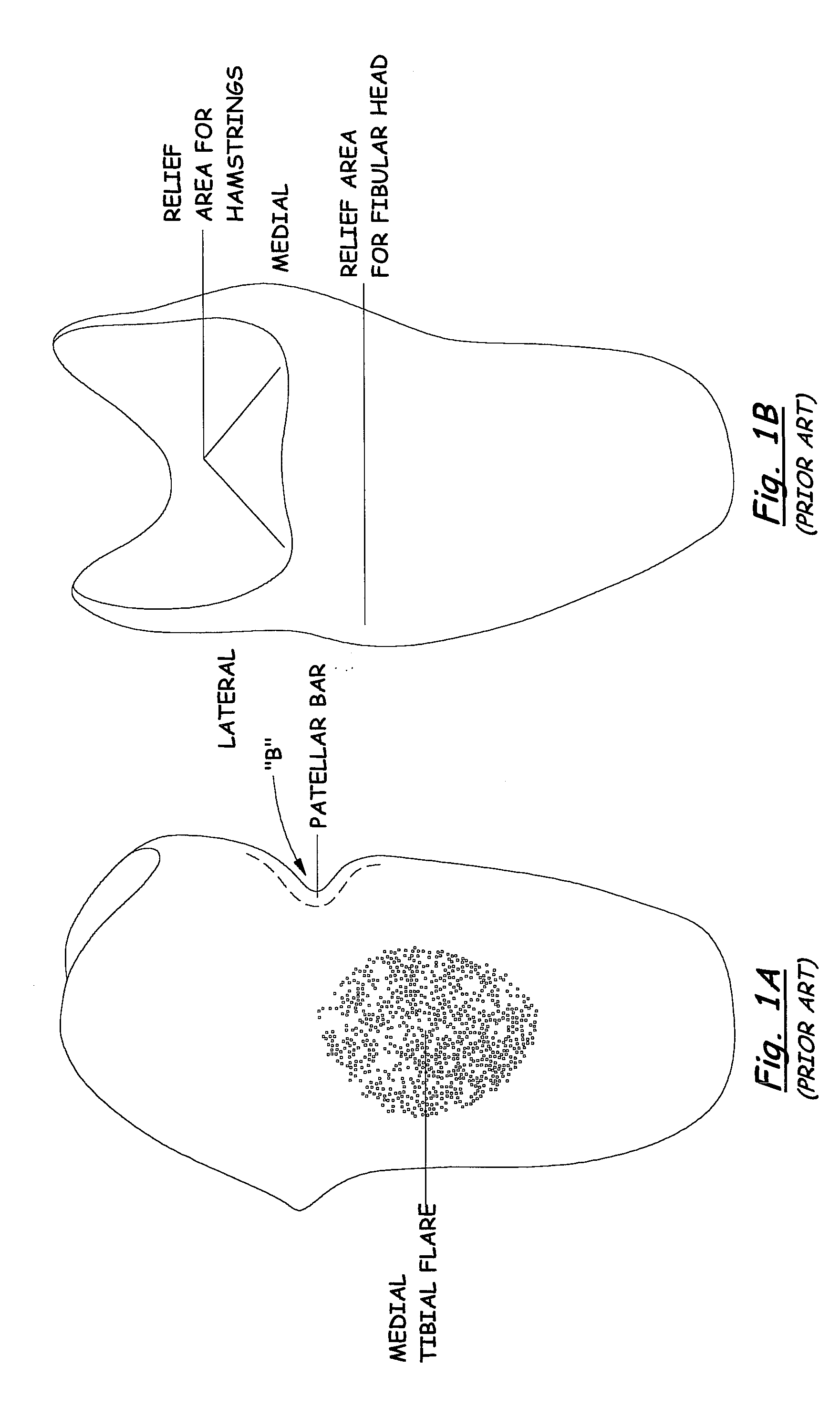 Transtibial socket for external prosthesis