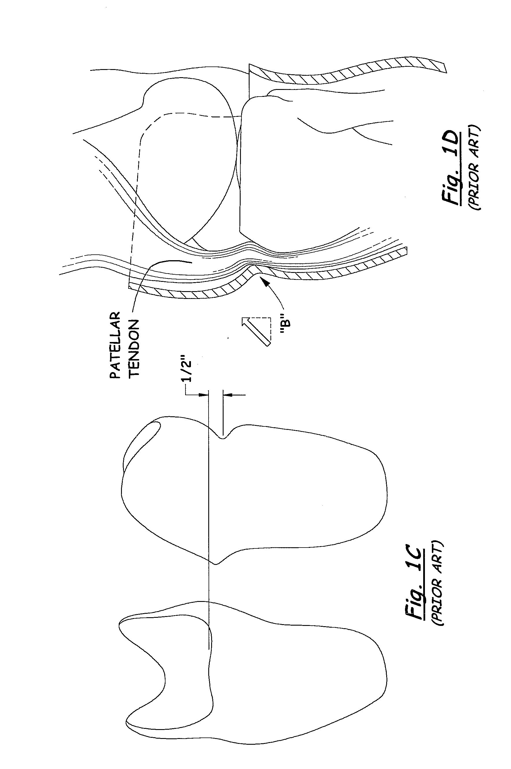 Transtibial socket for external prosthesis