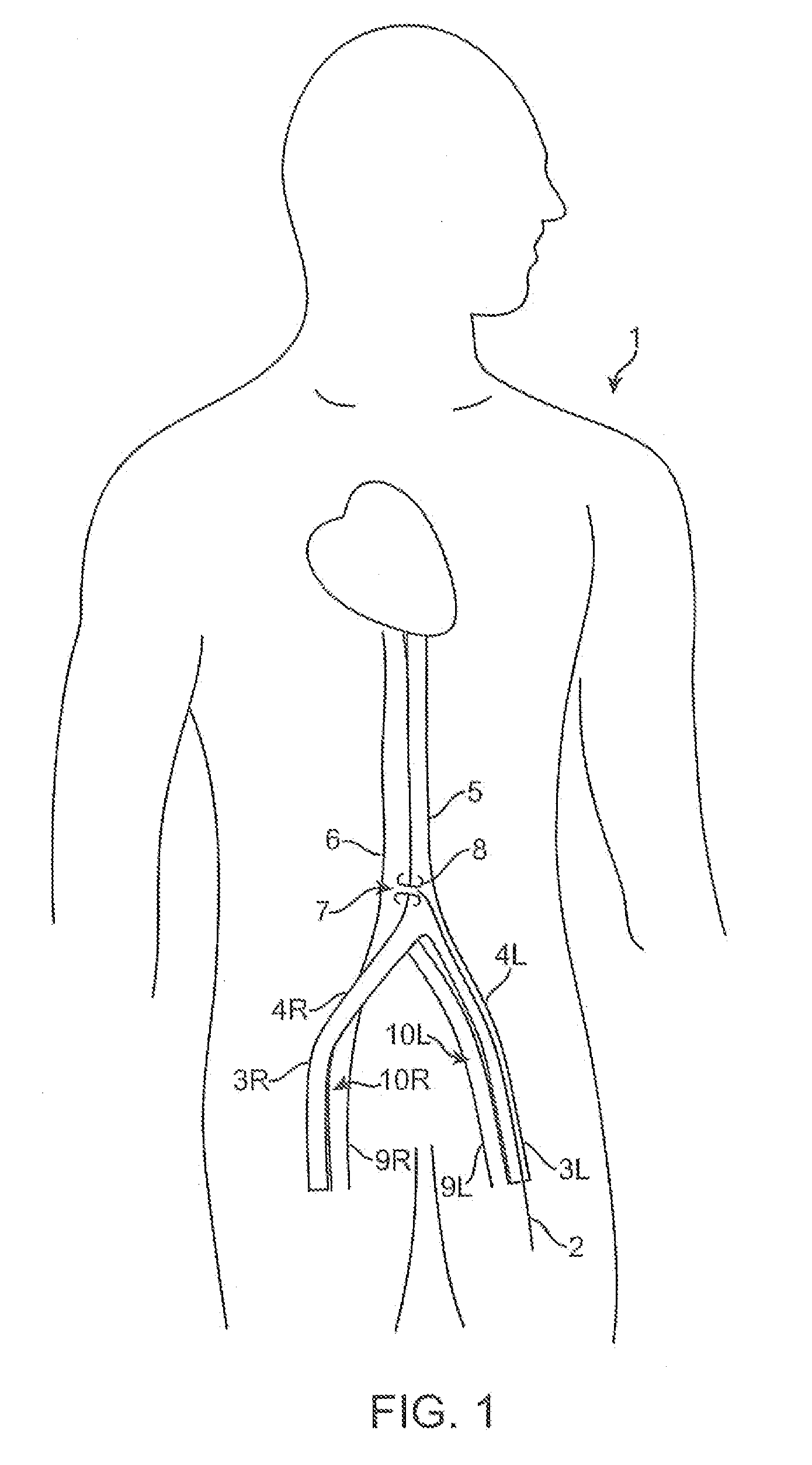 Device and method for establishing an artificial arterio-venous fistula