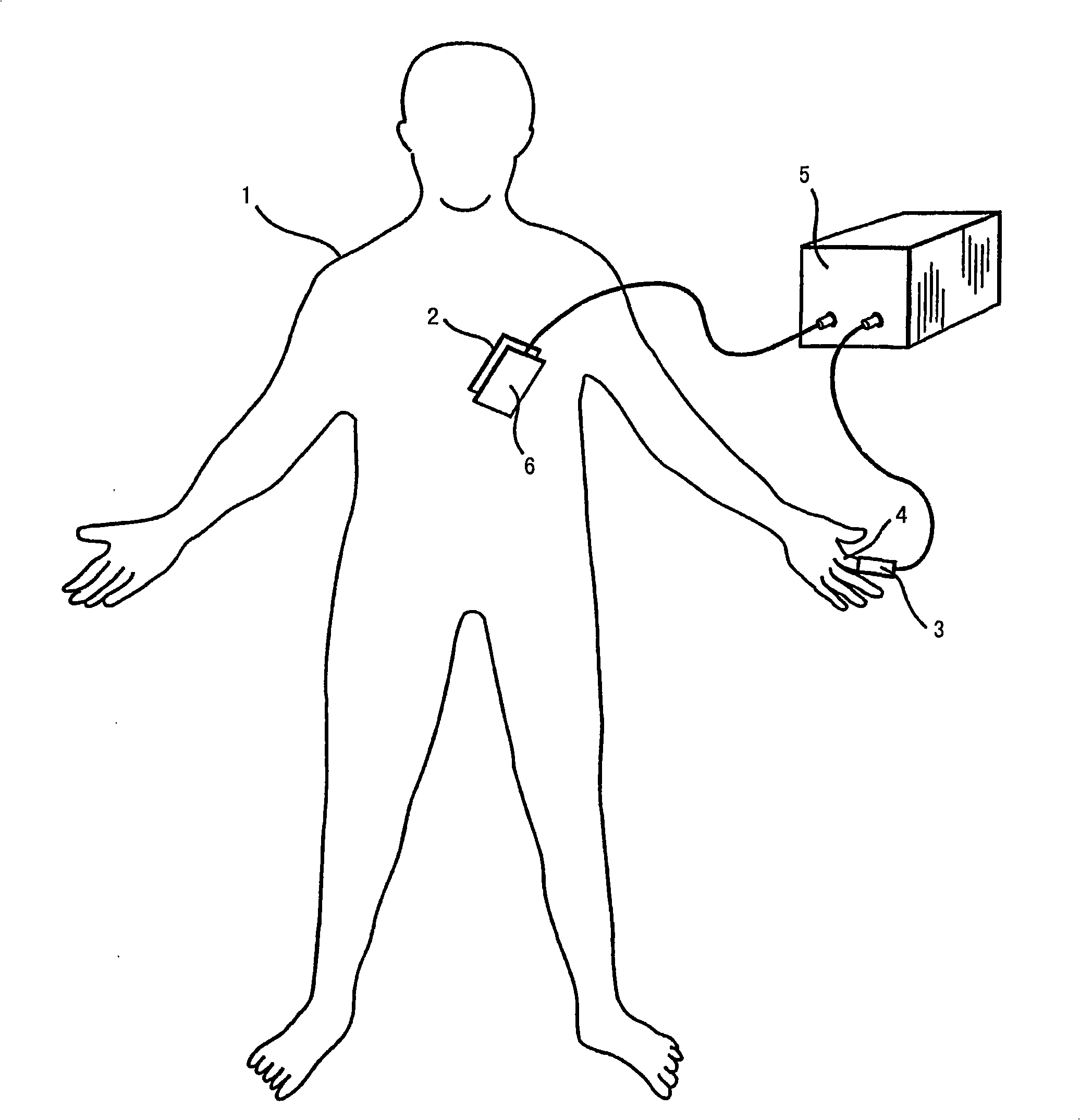 An apparatus and a method for programming a pacemaker