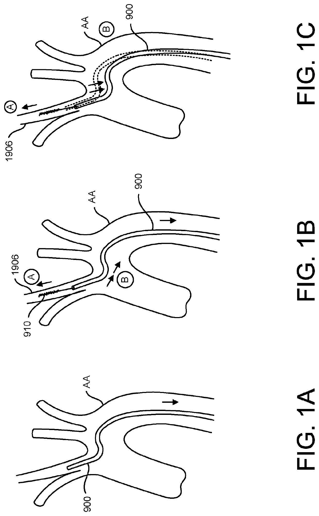 Methods of intracerebral implant delivery